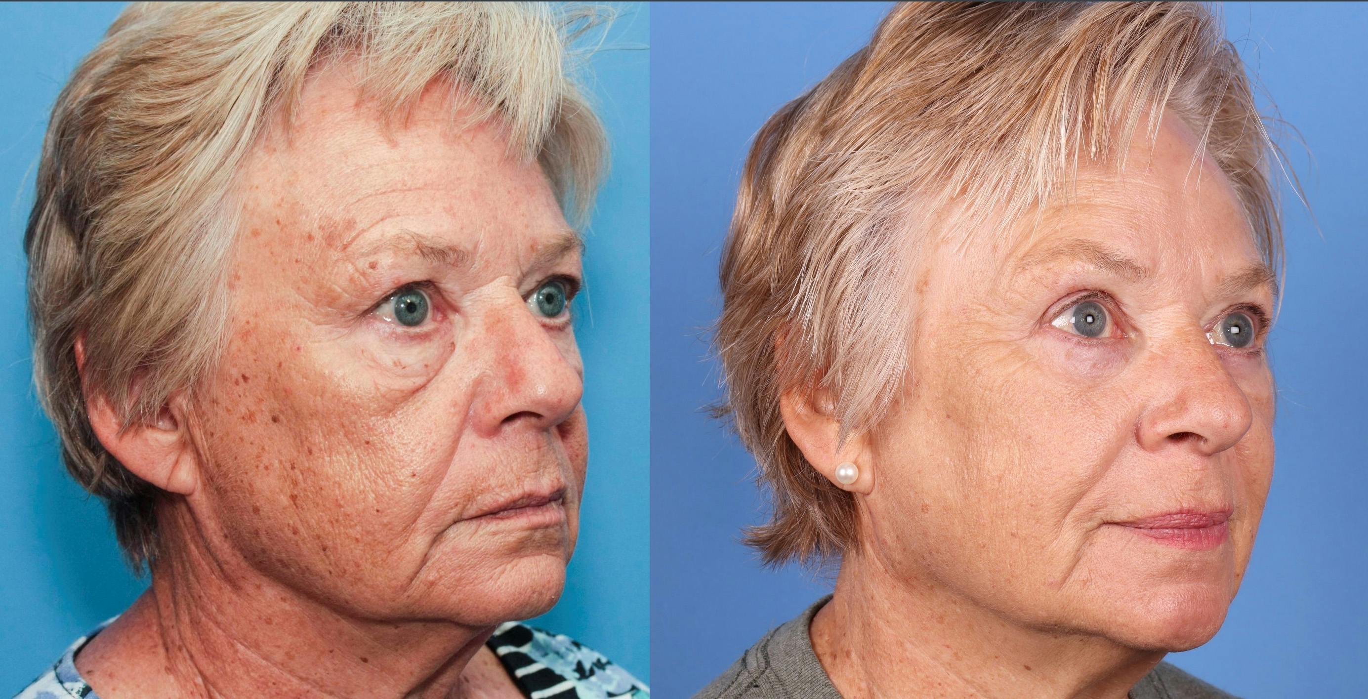 Eyelid Surgery (Upper & Lower Blepharoplasty) Before & After Gallery - Patient 277885 - Image 2