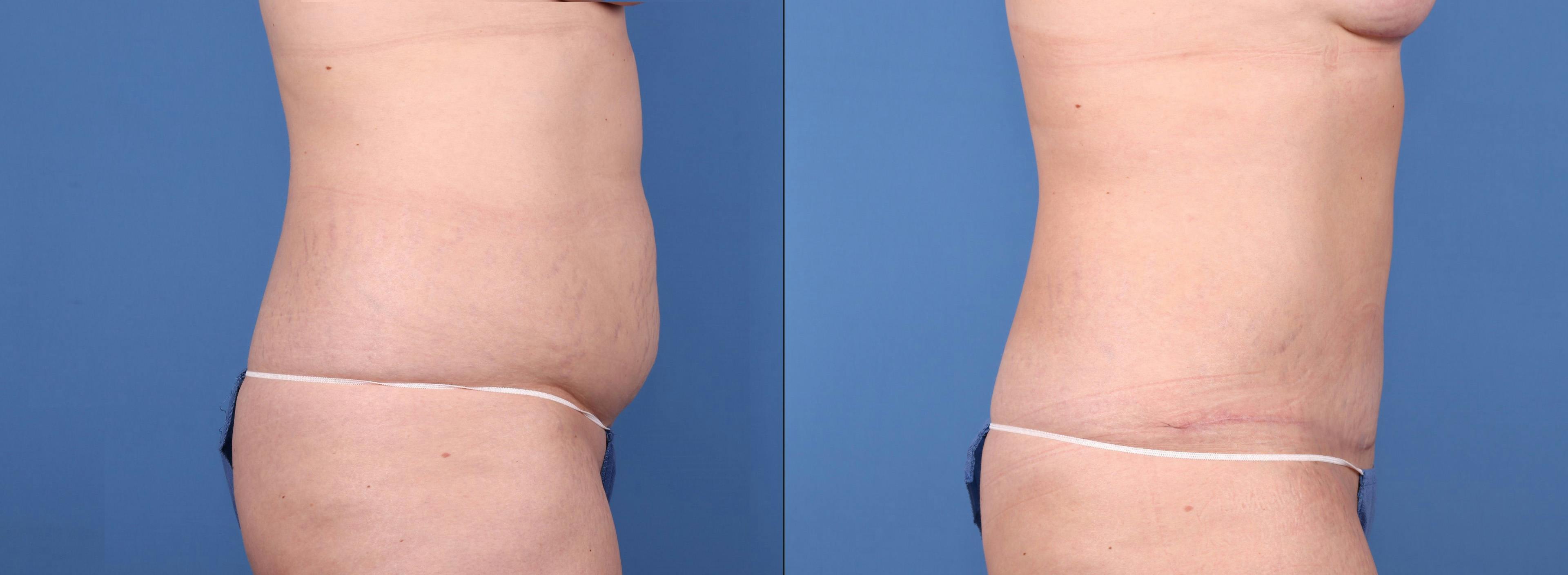 Tummy Tuck Gallery - Patient 122393948 - Image 4