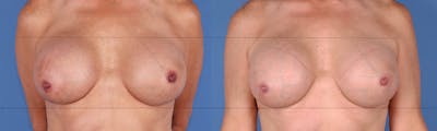 Aspen After Surgery Before & After Gallery - Patient 122403039 - Image 1
