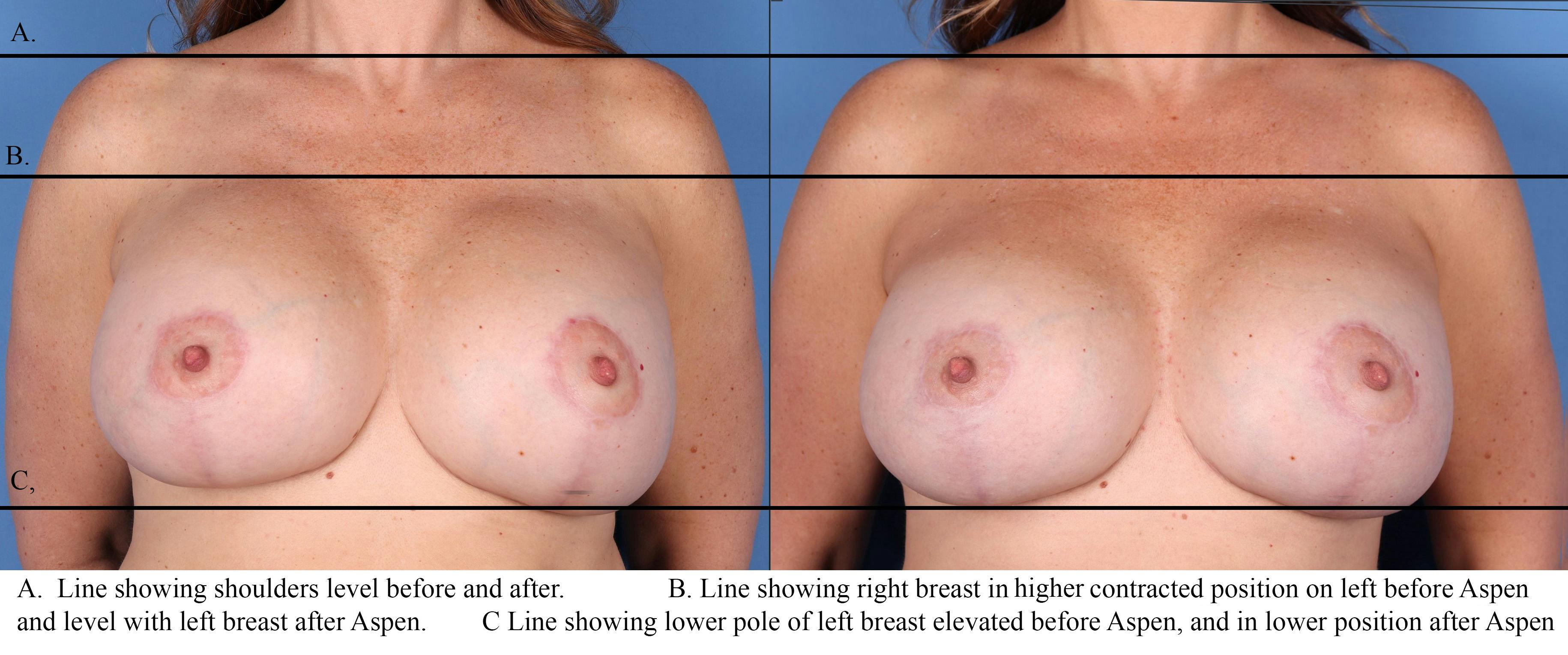 Breast Revision Before & After Gallery - Patient 122404148 - Image 1