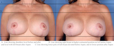 Breast Revision Before & After Gallery - Patient 122404148 - Image 1