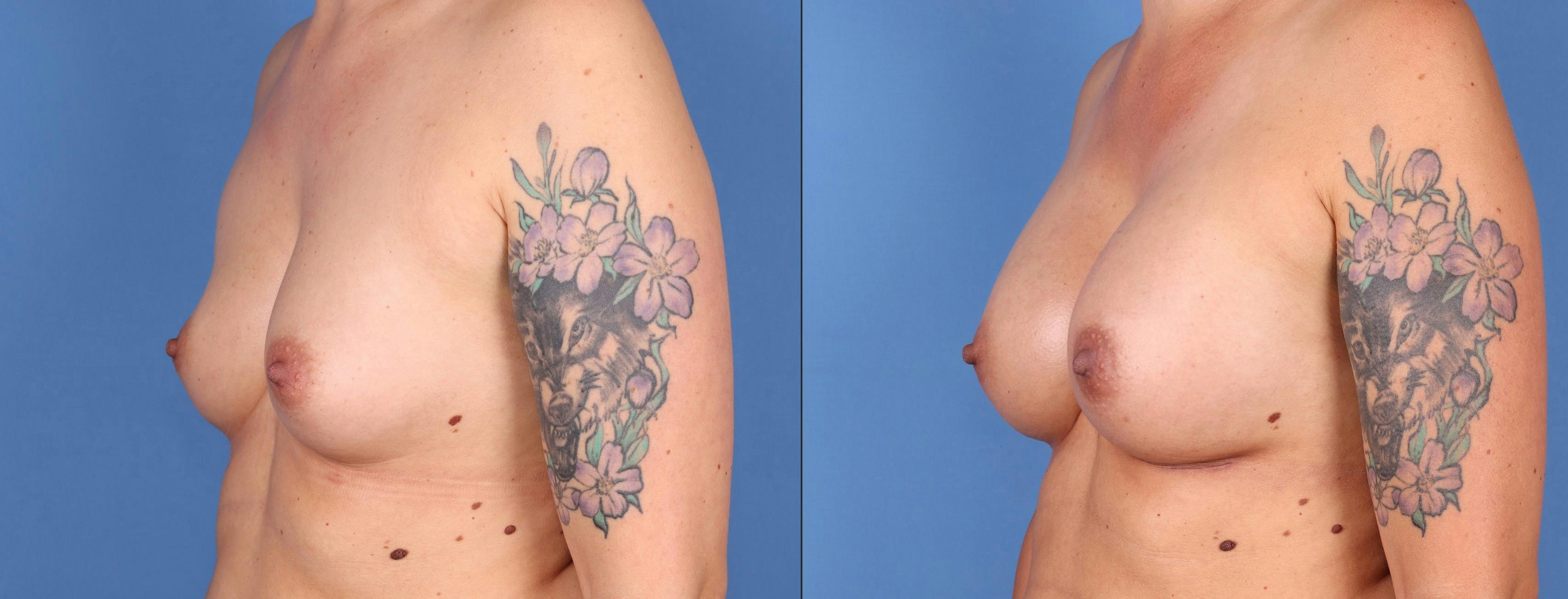 Breast Augmentation Before & After Gallery - Patient 122597788 - Image 2