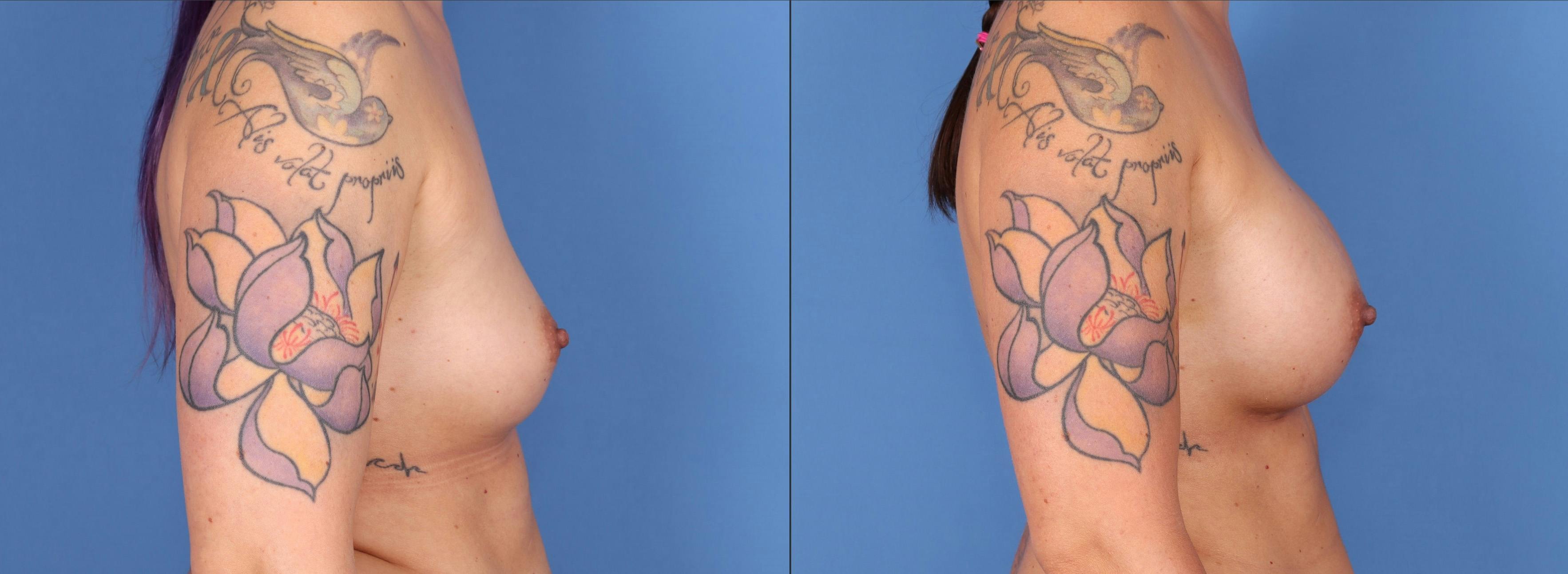 Breast Augmentation Gallery - Patient 122597788 - Image 3