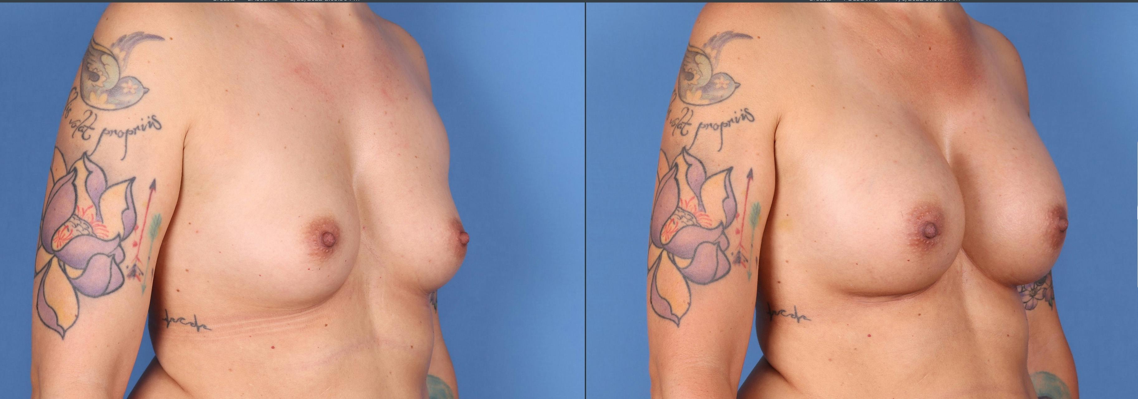 Breast Augmentation Before & After Gallery - Patient 122597788 - Image 4