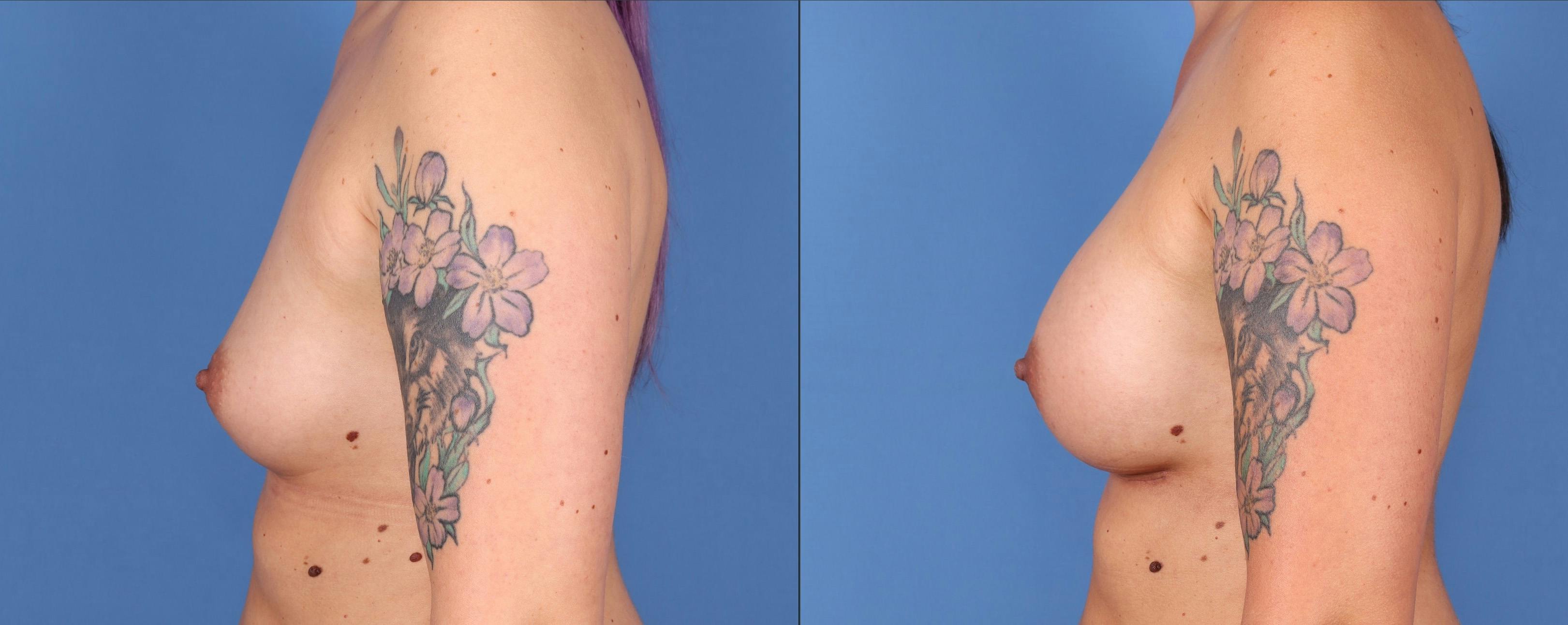 Breast Augmentation Before & After Gallery - Patient 122597788 - Image 5
