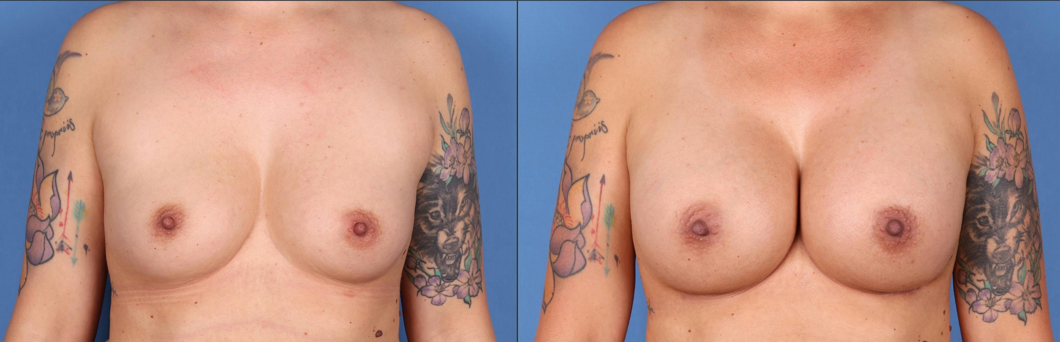 Breast Augmentation Before & After Gallery - Patient 122597788 - Image 1