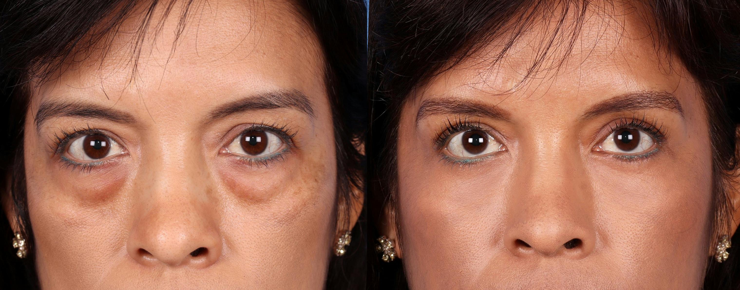 Eyelid Surgery (Blepharoplasty) Before & After Gallery - Patient 122608270 - Image 1