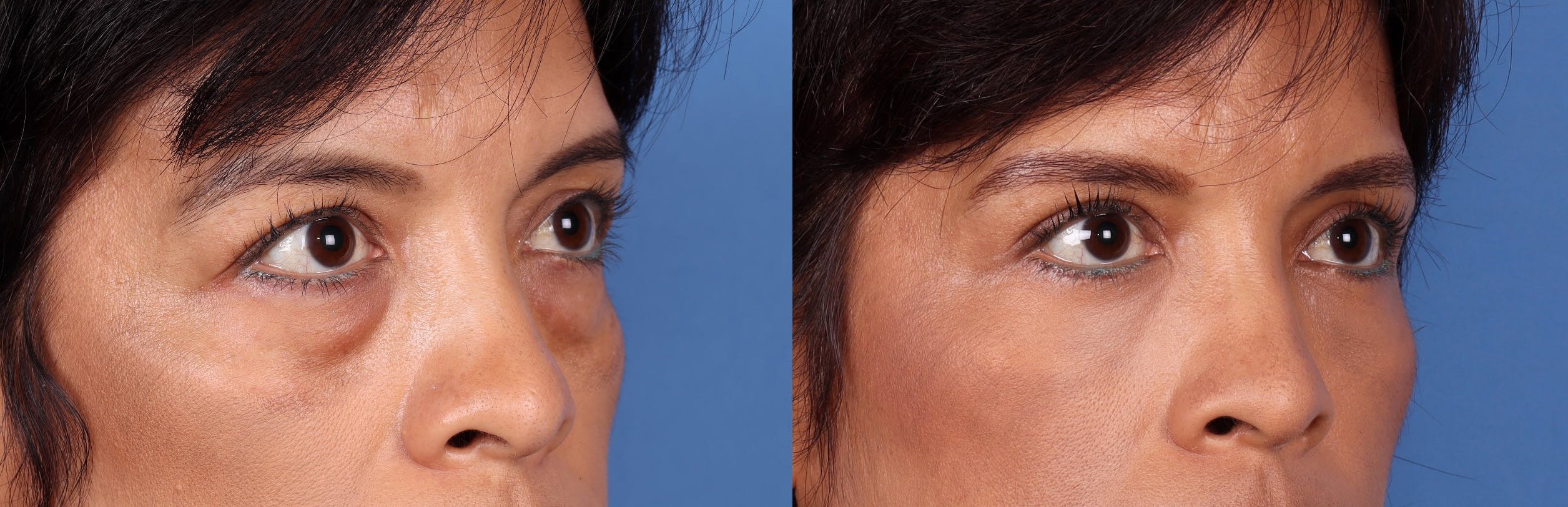 Eyelid Surgery (Blepharoplasty) Before & After Gallery - Patient 122608270 - Image 2