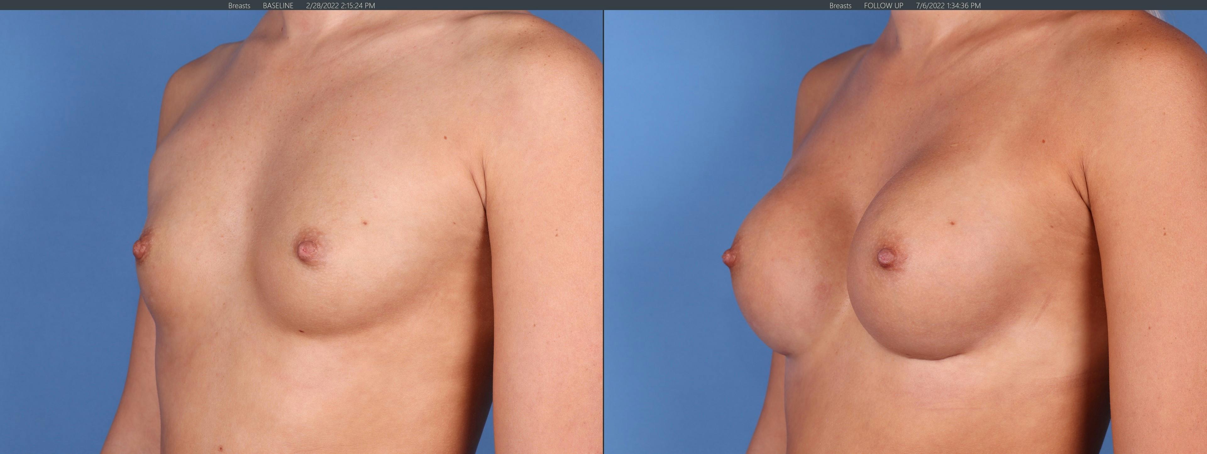 Breast Augmentation Gallery - Patient 122608777 - Image 2