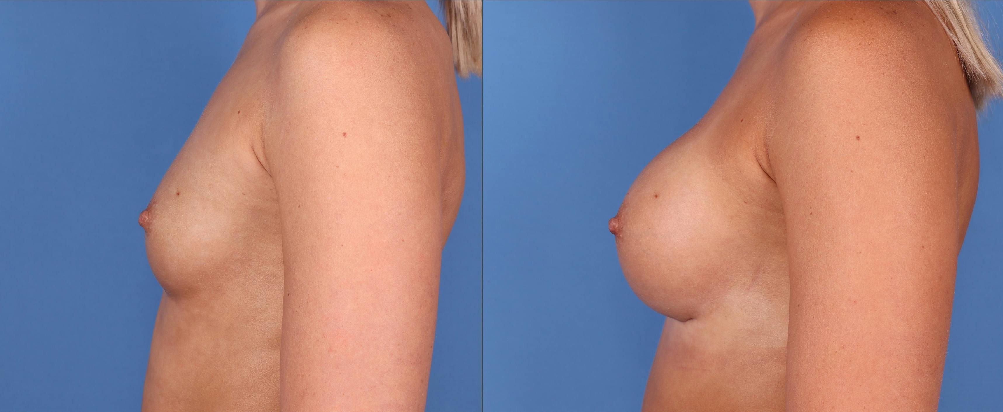 Breast Augmentation Before & After Gallery - Patient 122608777 - Image 3