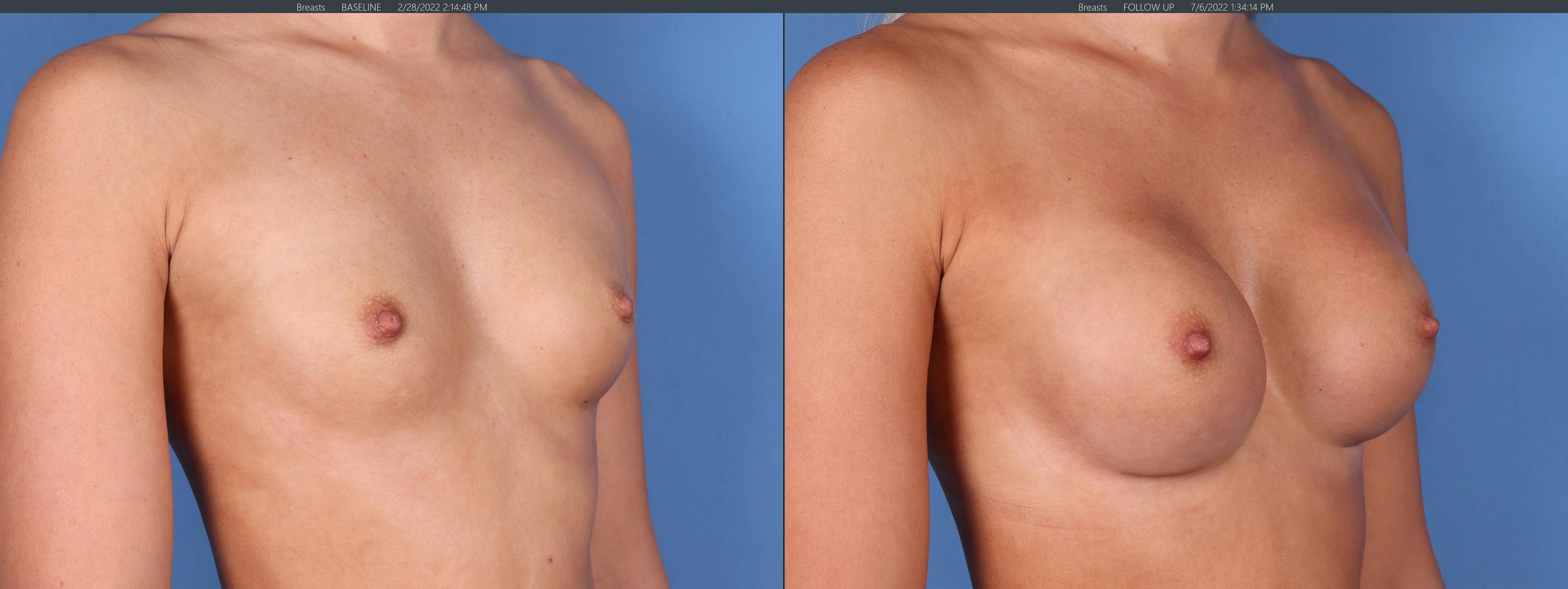 Breast Augmentation Before & After Gallery - Patient 122608777 - Image 4