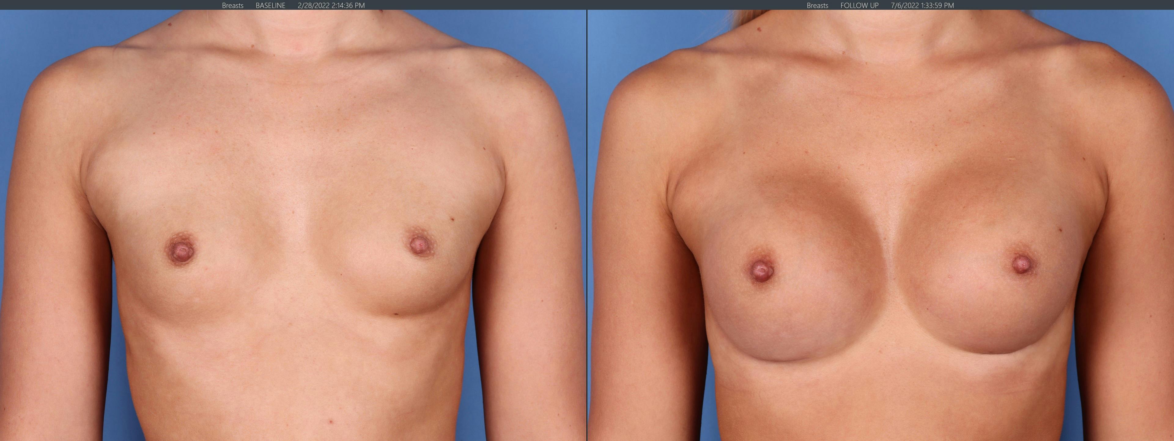 Breast Augmentation Before & After Gallery - Patient 122608777 - Image 1