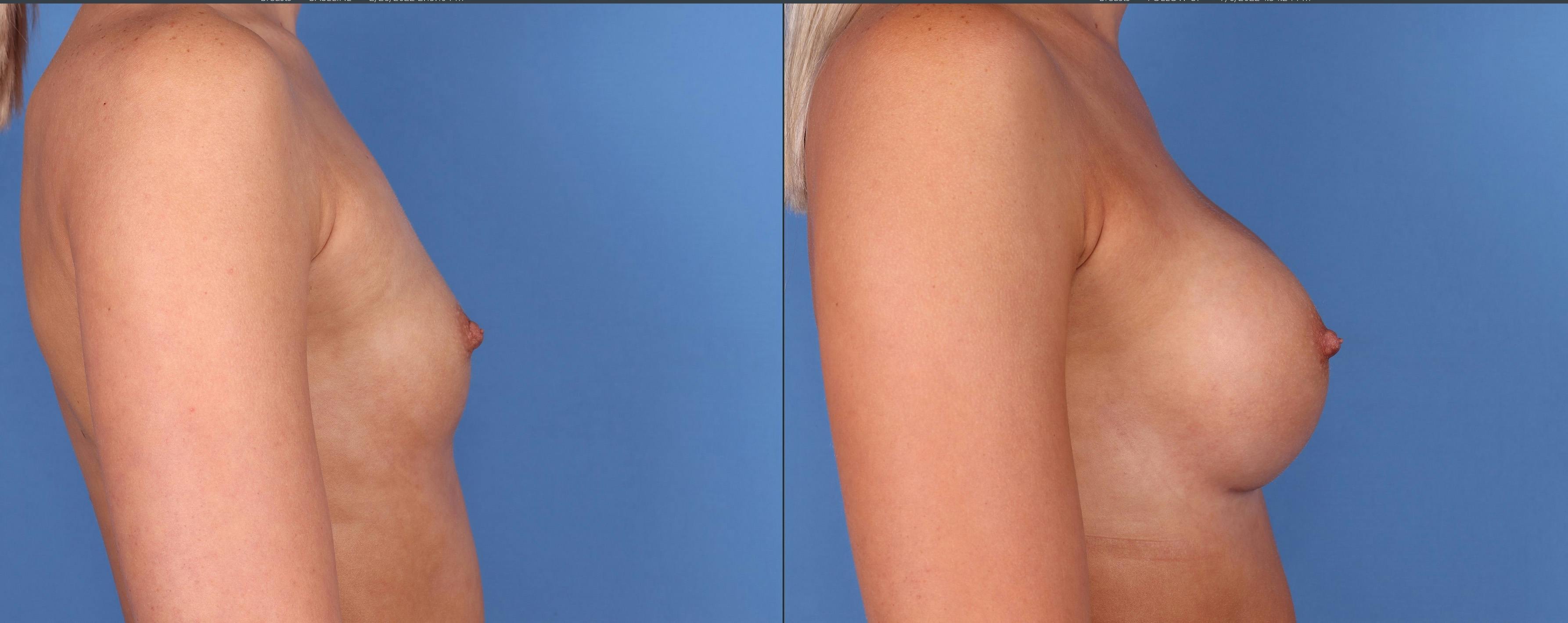Breast Augmentation Before & After Gallery - Patient 122608777 - Image 5