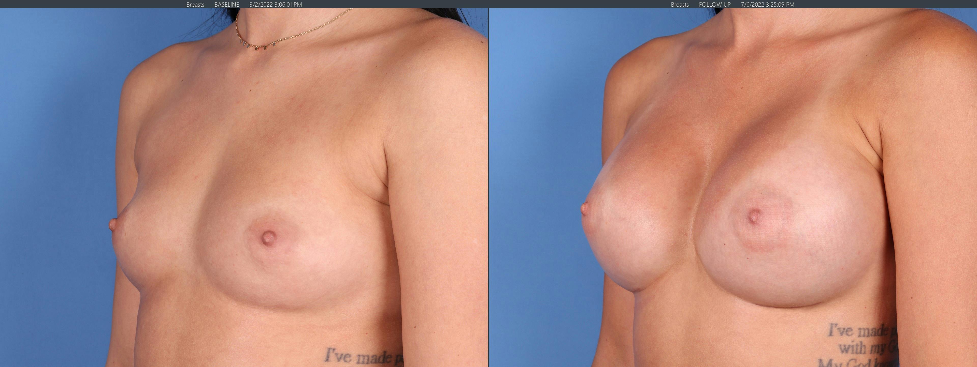 Breast Augmentation Before & After Gallery - Patient 122608815 - Image 1