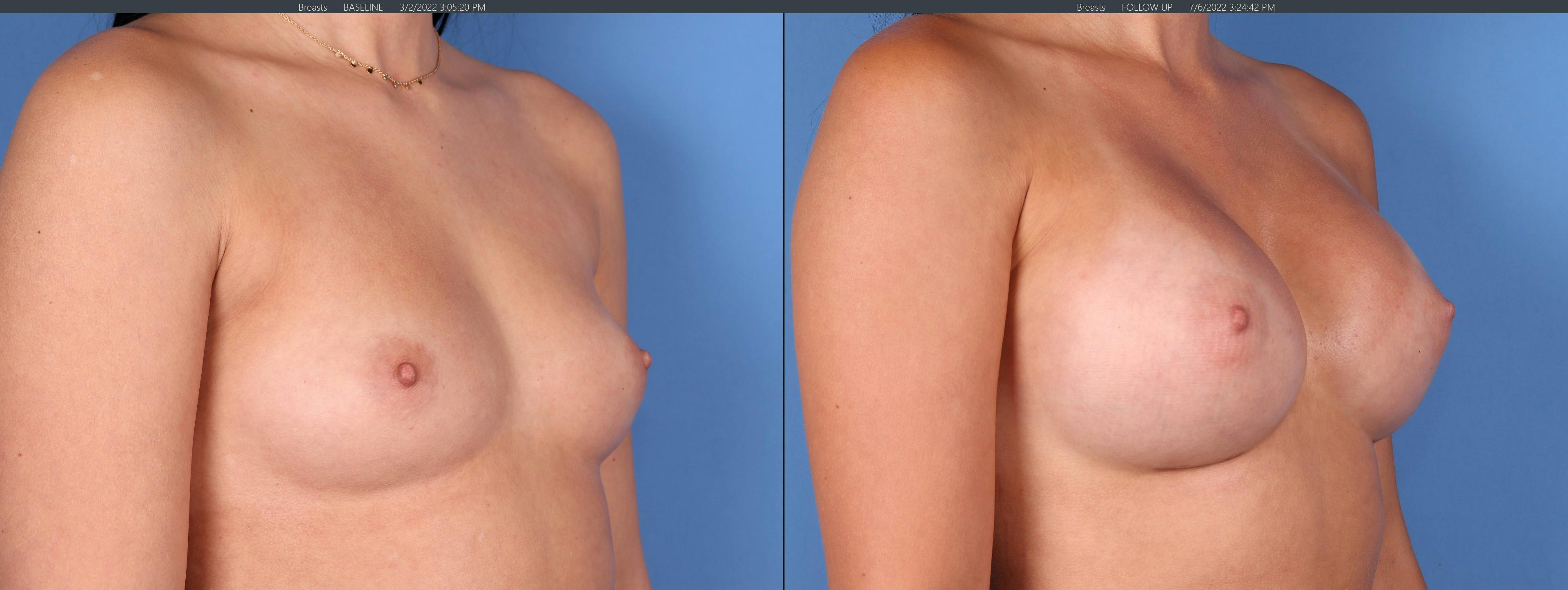 Breast Augmentation Before & After Gallery - Patient 122608815 - Image 2