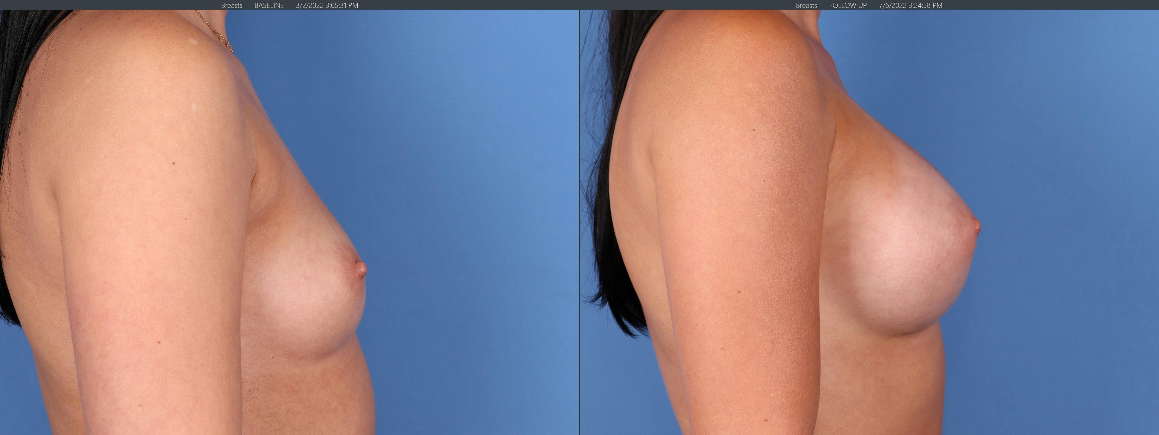 Breast Augmentation Before & After Gallery - Patient 122608815 - Image 3