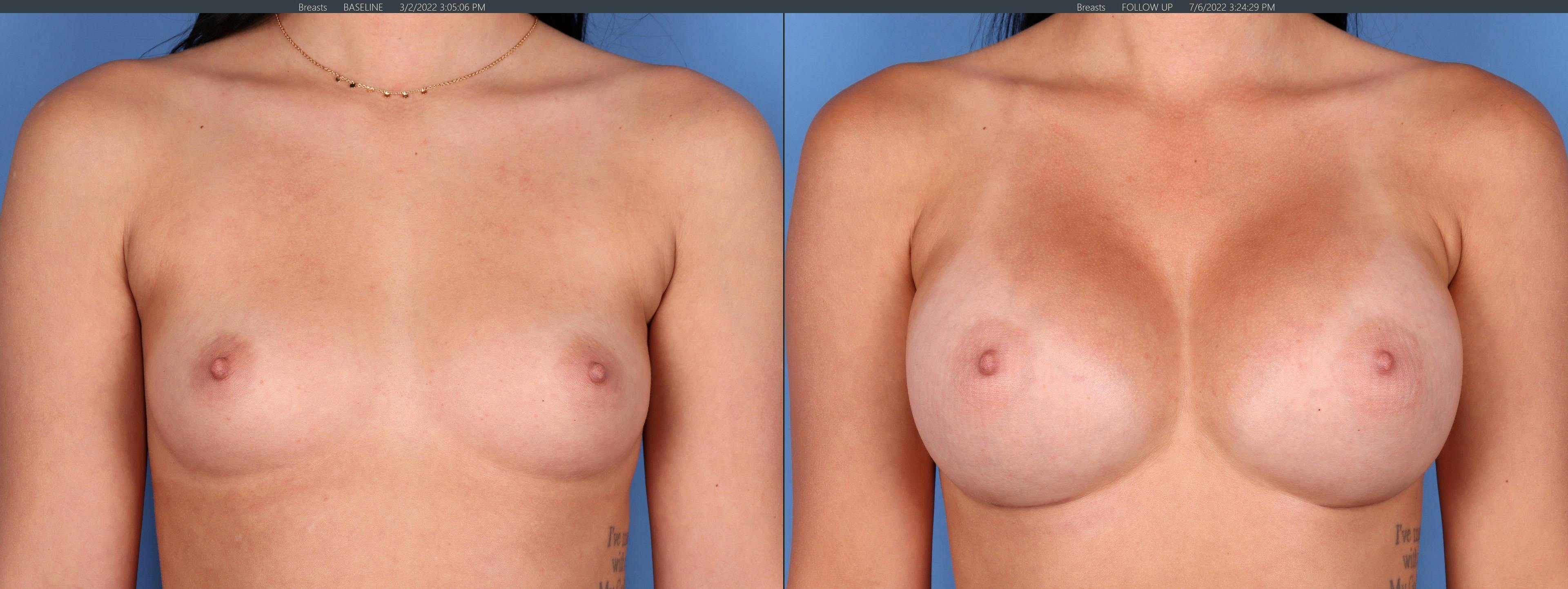 Breast Augmentation Before & After Gallery - Patient 122608815 - Image 4