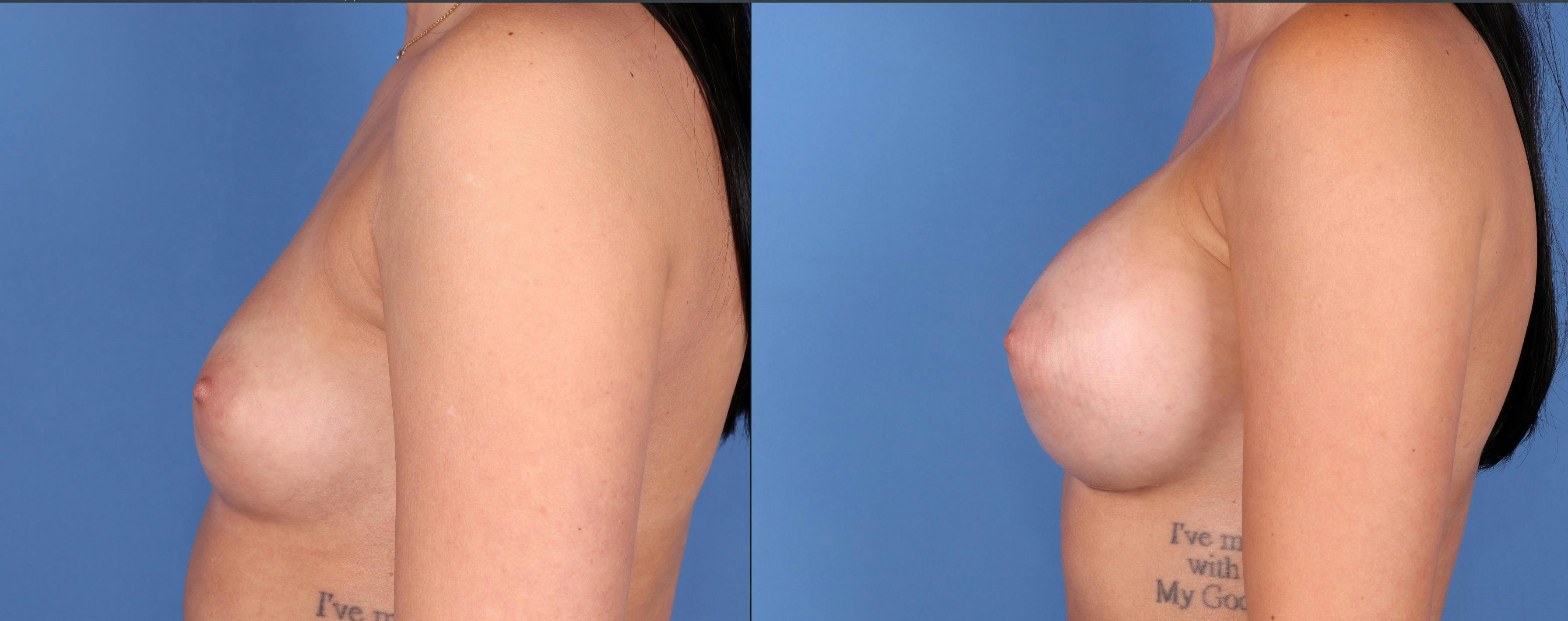 Breast Augmentation Before & After Gallery - Patient 122608815 - Image 5