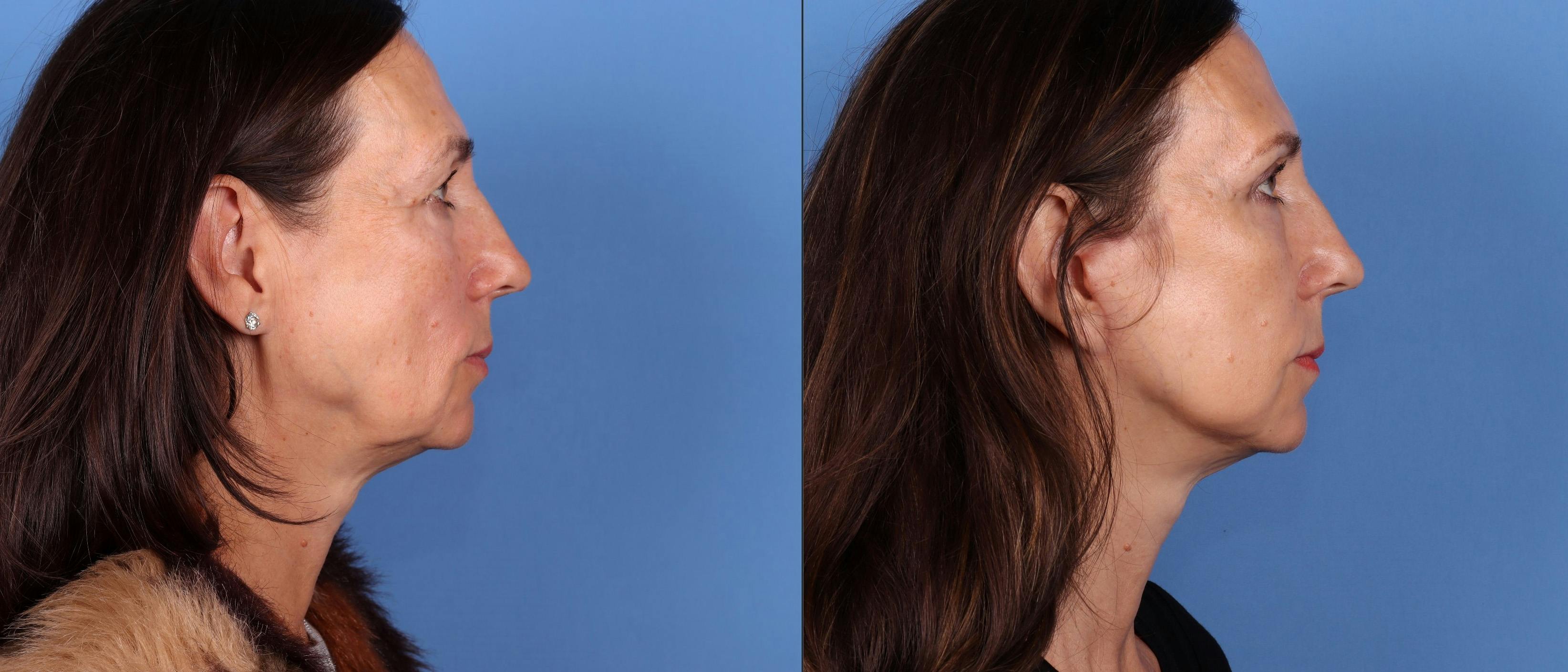 Eyelid Surgery (Upper Blepharoplasty) Before & After Gallery - Patient 122682730 - Image 3