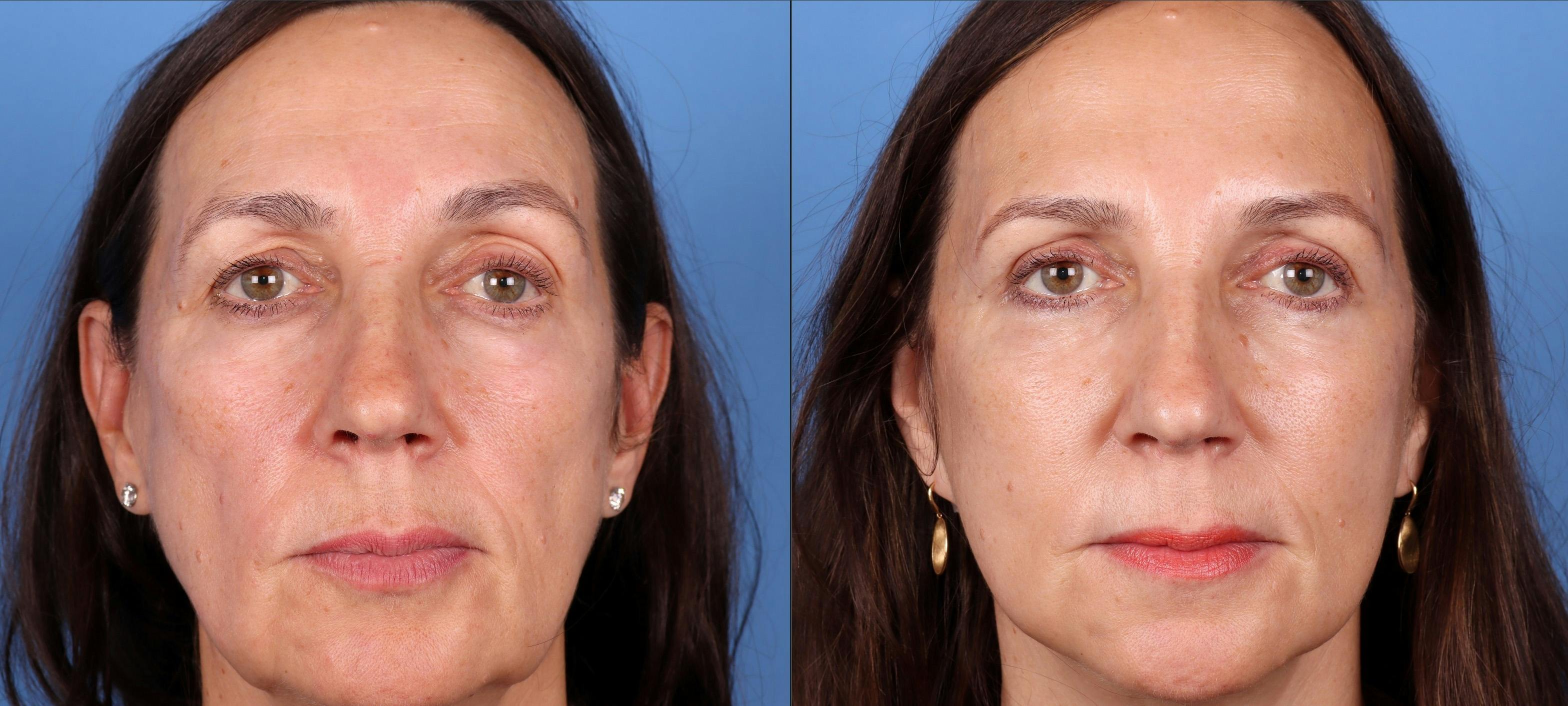 Eyelid Surgery (Blepharoplasty) Before & After Gallery - Patient 122682730 - Image 1