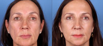 Eyelid Surgery (Upper Blepharoplasty) Before & After Gallery - Patient 122682730 - Image 1