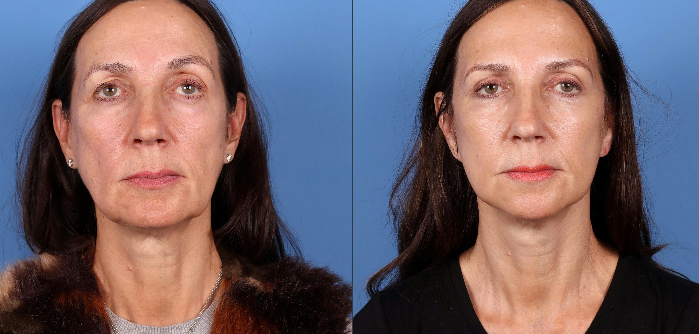 Eyelid Surgery (Upper Blepharoplasty) Before & After Gallery - Patient 122682730 - Image 5