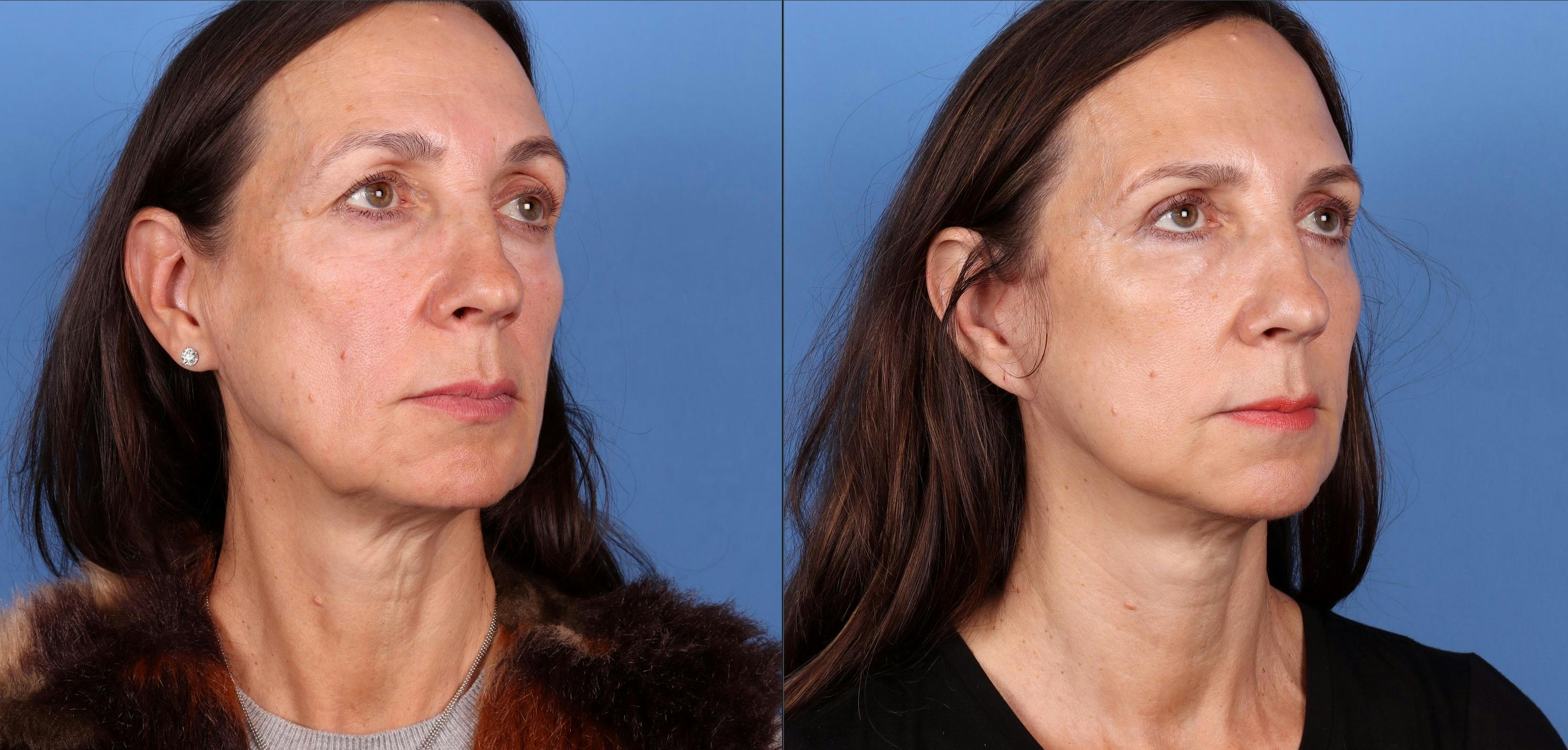 Eyelid Surgery (Upper Blepharoplasty) Before & After Gallery - Patient 122682730 - Image 2