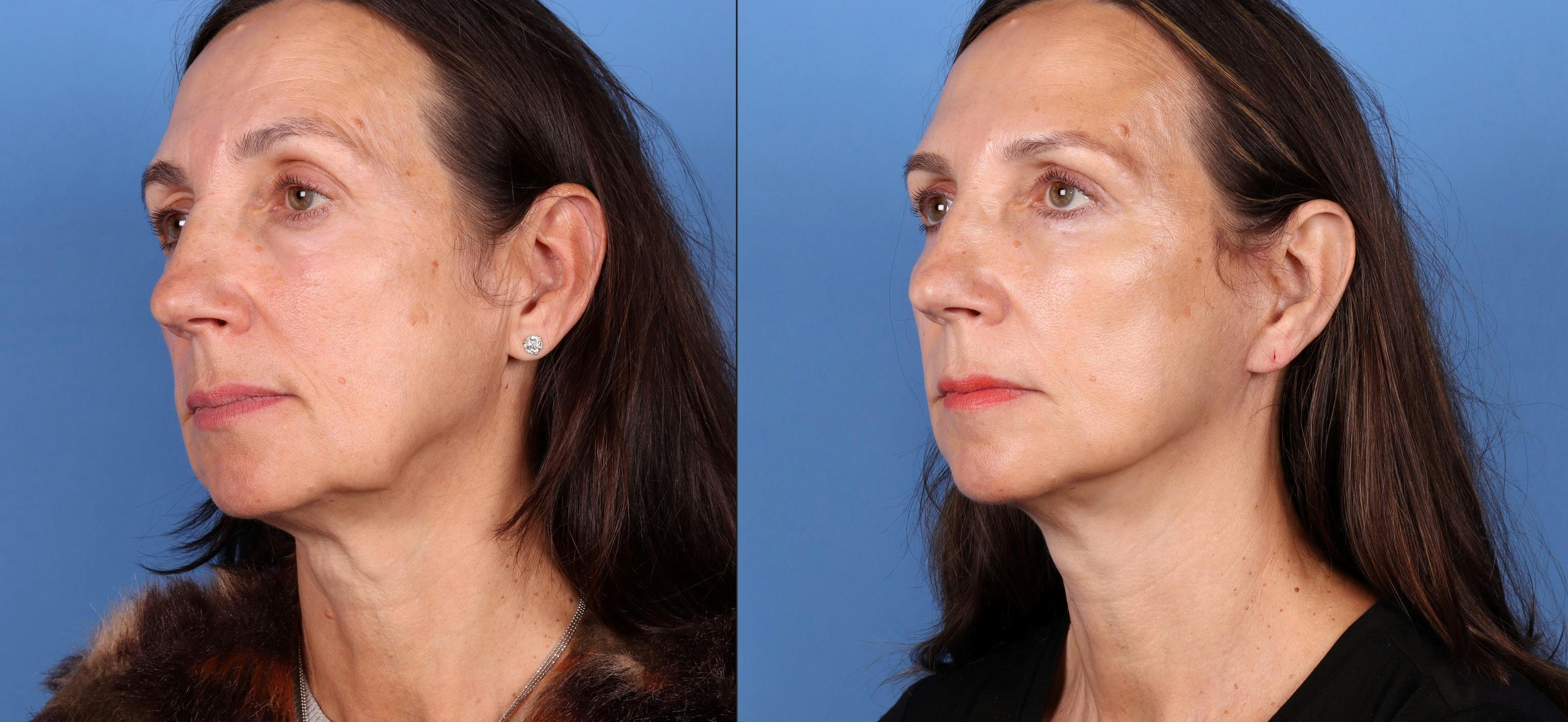 Eyelid Surgery (Blepharoplasty) Before & After Gallery - Patient 122682730 - Image 4