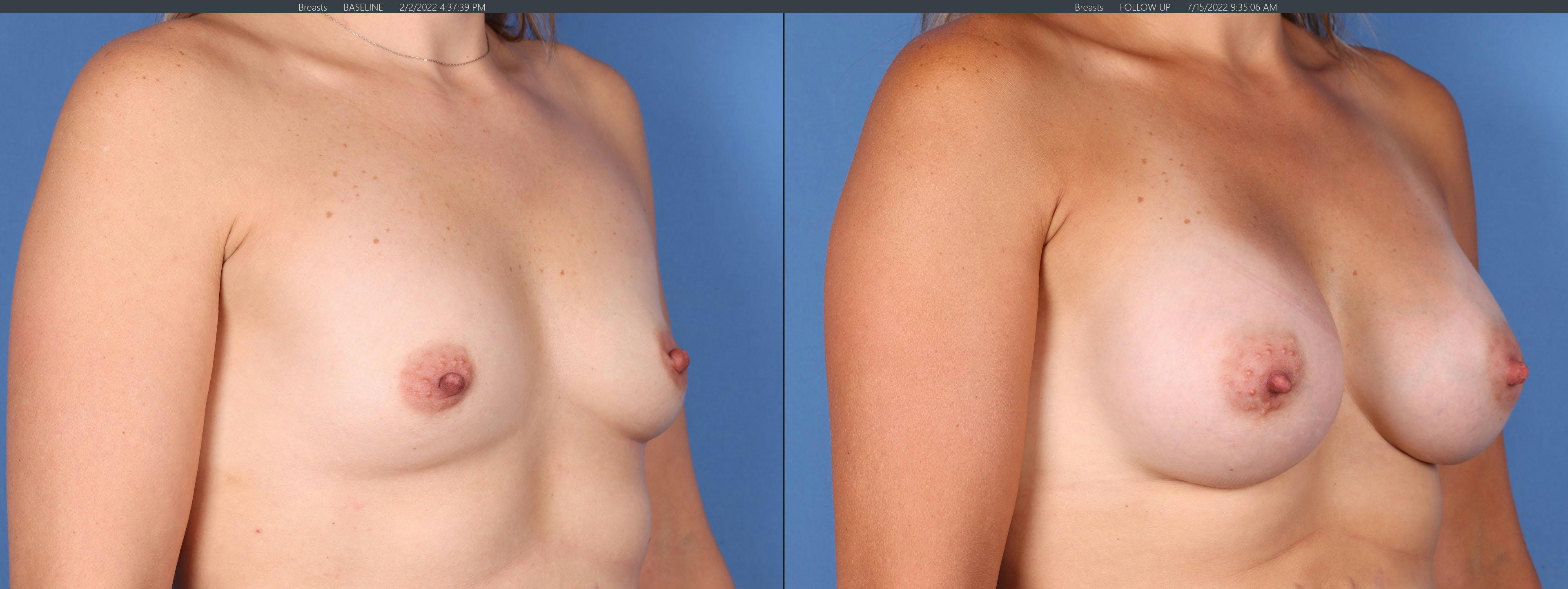 Breast Augmentation Before & After Gallery - Patient 122771112 - Image 2