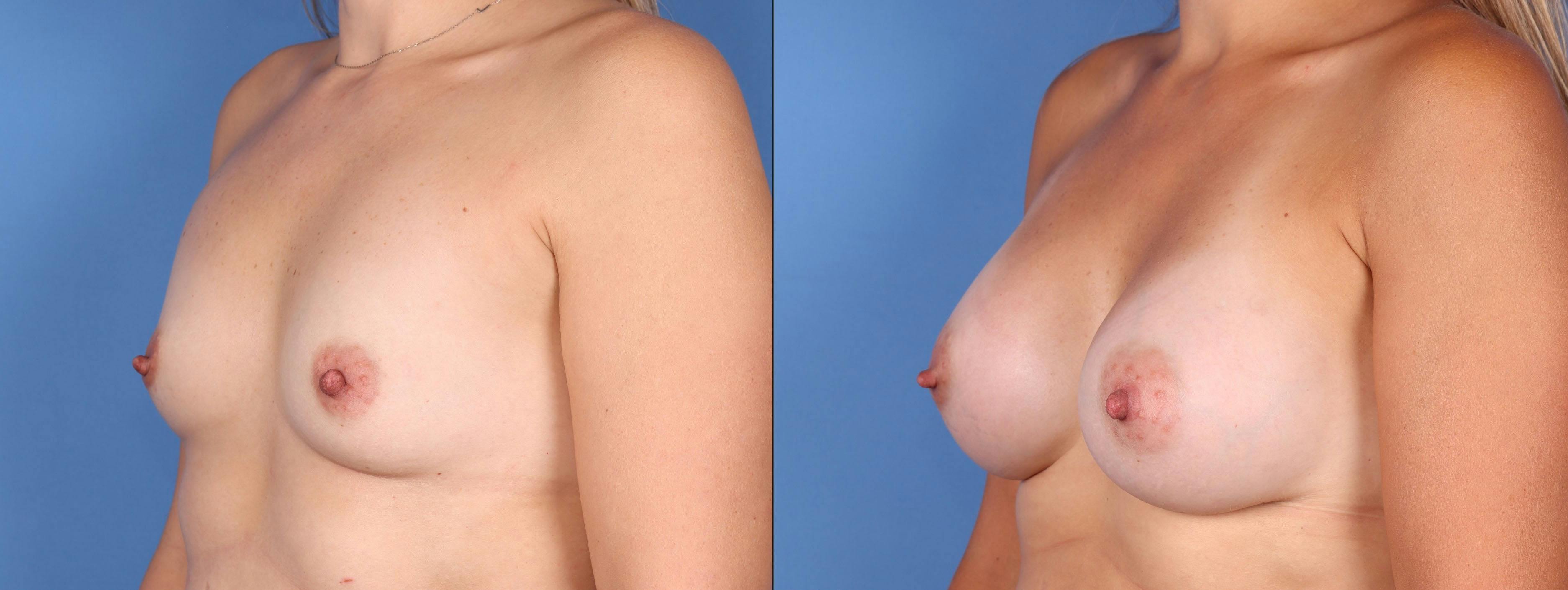 Breast Augmentation Before & After Gallery - Patient 122771112 - Image 4