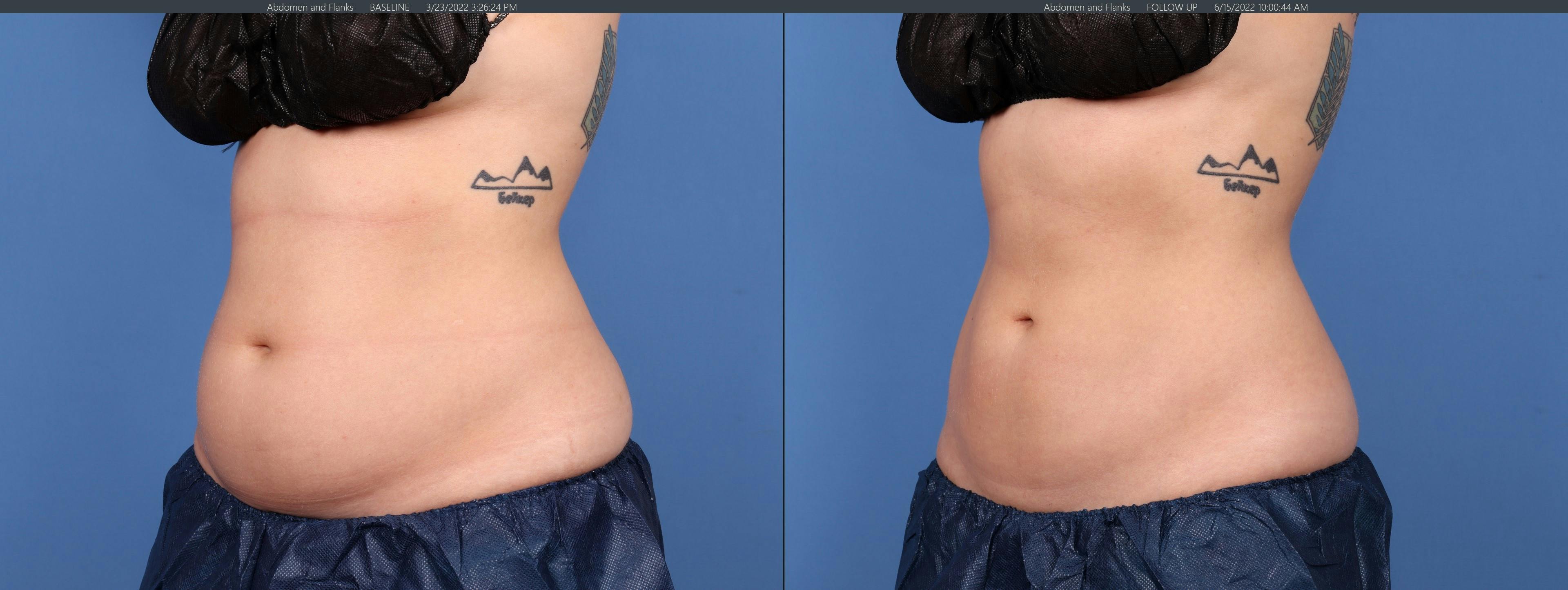 Body Before & After Gallery - Patient 122771125 - Image 2