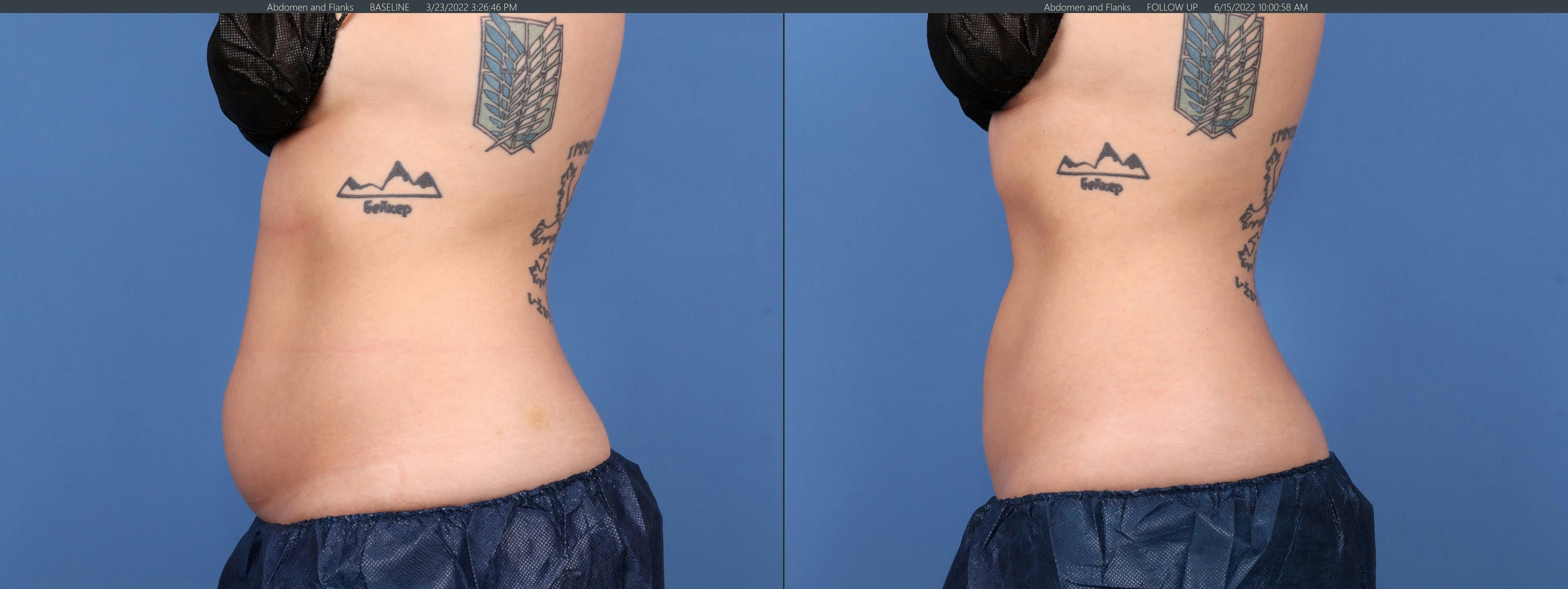 Body Before & After Gallery - Patient 122771125 - Image 3