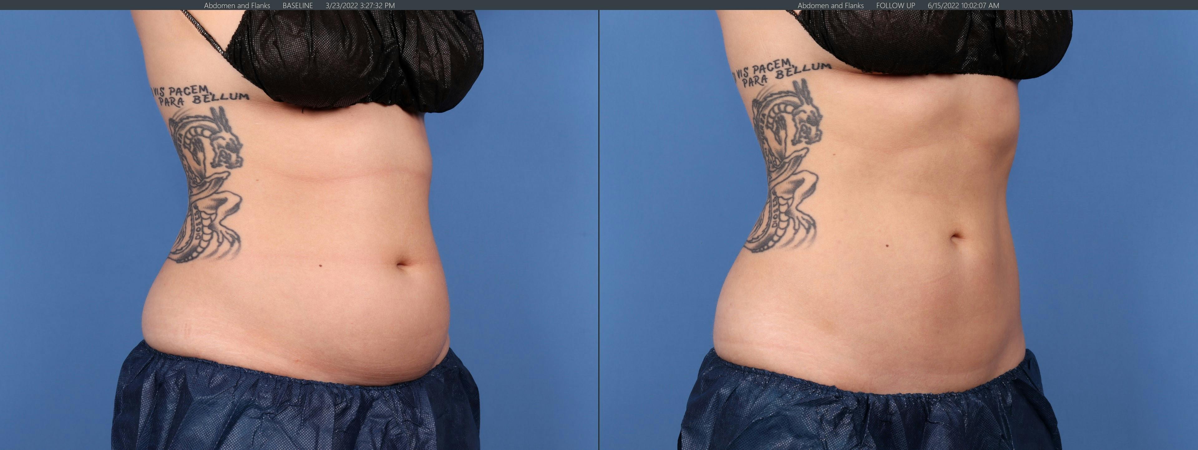 Body Before & After Gallery - Patient 122771125 - Image 4