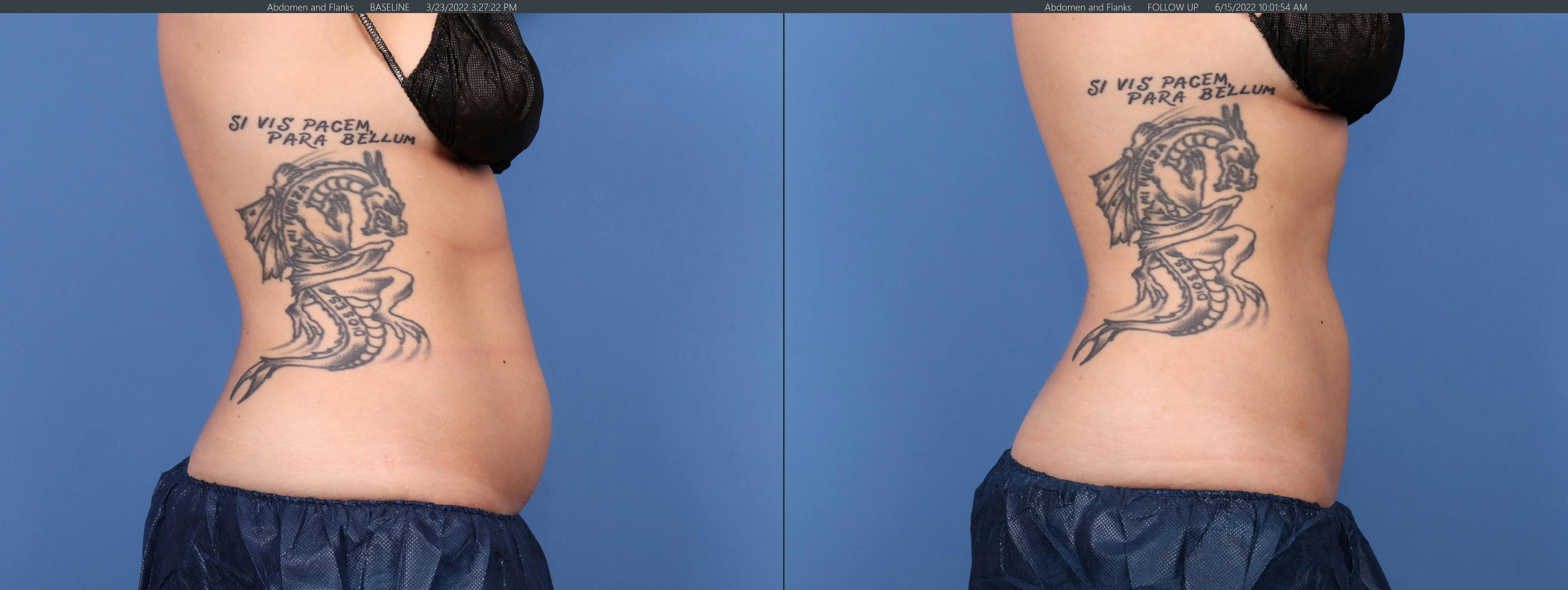 Body Before & After Gallery - Patient 122771125 - Image 5