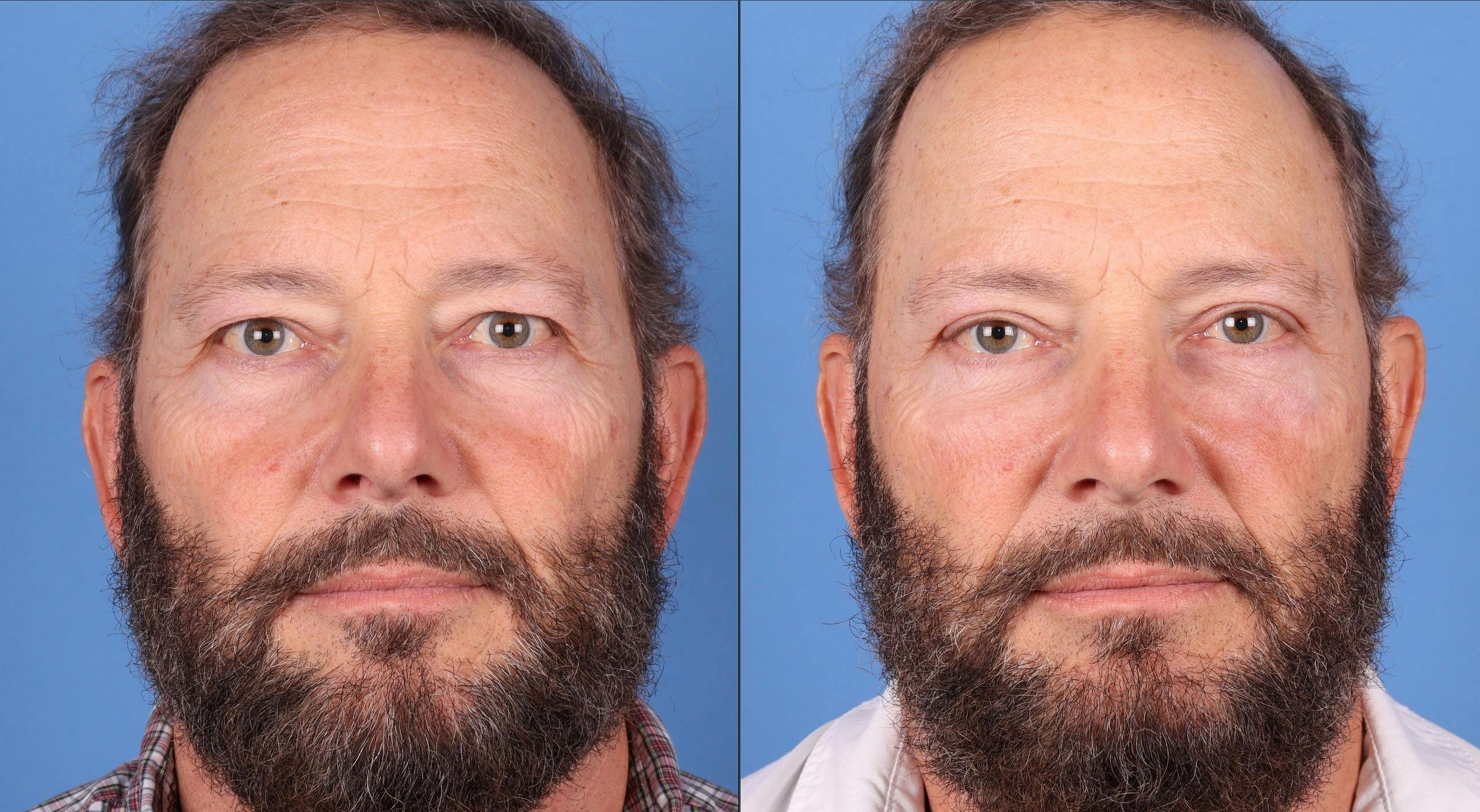 Eyelid Surgery (Upper & Lower Blepharoplasty) Before & After Gallery - Patient 395109 - Image 1