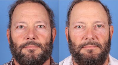 Eyelid Surgery (Upper & Lower Blepharoplasty) Before & After Gallery - Patient 395109 - Image 1