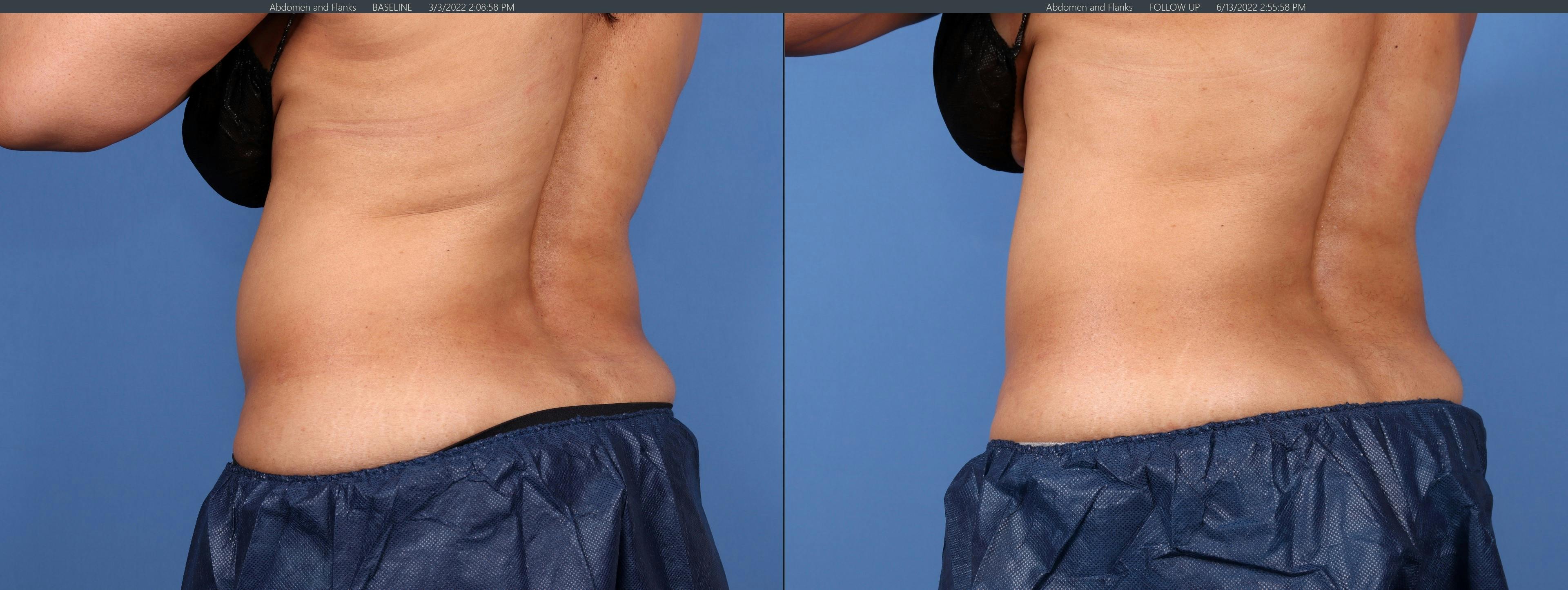Body Before & After Gallery - Patient 122771249 - Image 1