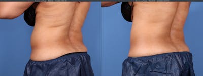 Body Before & After Gallery - Patient 122771249 - Image 1