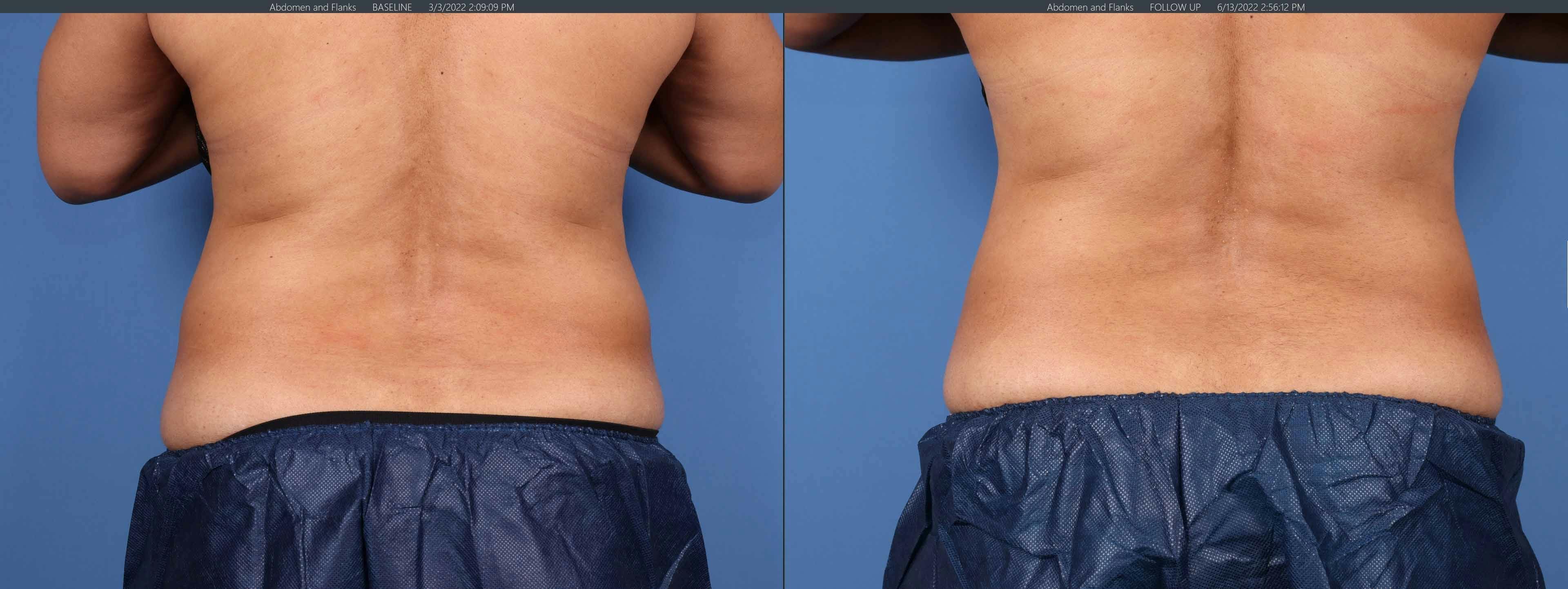 Body Before & After Gallery - Patient 122771249 - Image 2