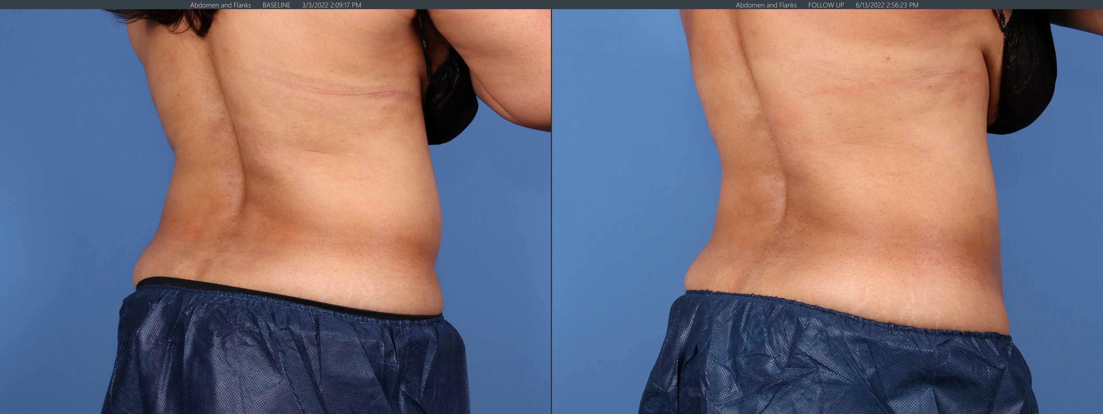 Body Before & After Gallery - Patient 122771249 - Image 3