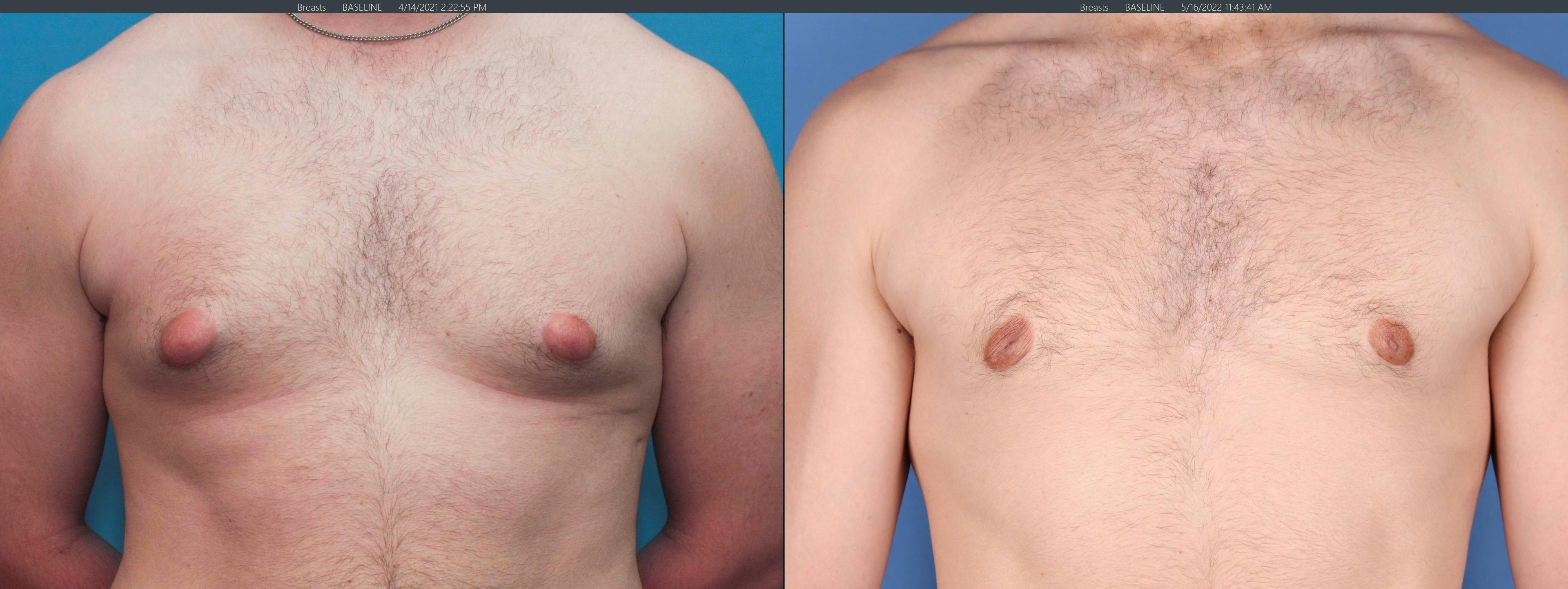 Male Breast Reduction Before & After Gallery - Patient 122832165 - Image 1