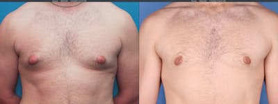 Male Breast Reduction Before & After Gallery - Patient 122832165 - Image 1