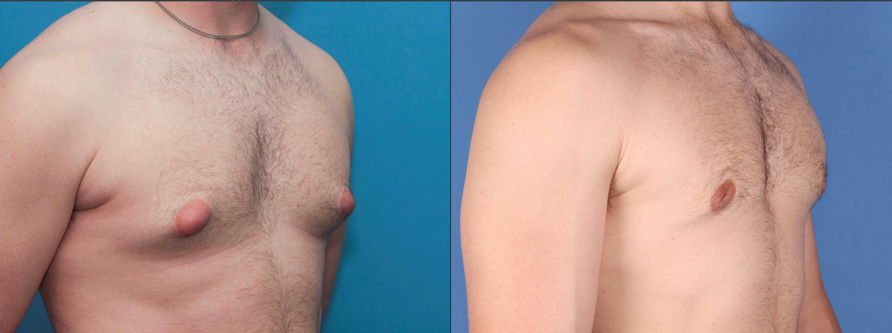 Male Breast Reduction Before & After Gallery - Patient 122832165 - Image 2