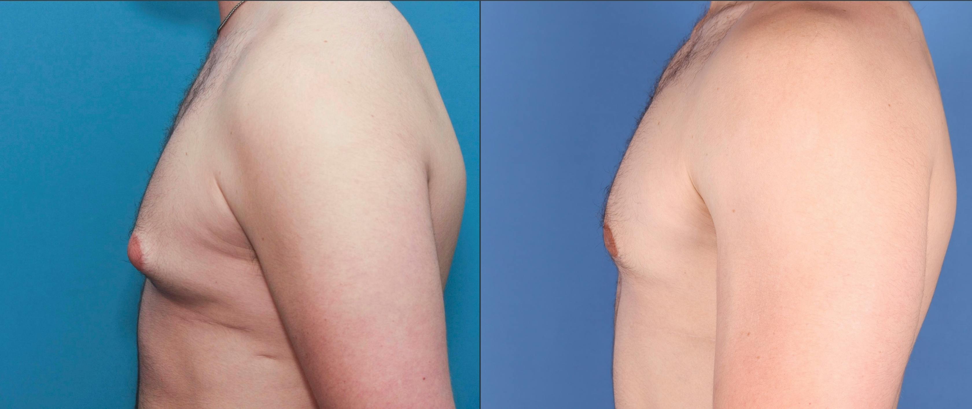 Liposuction Before & After Gallery - Patient 122832196 - Image 3