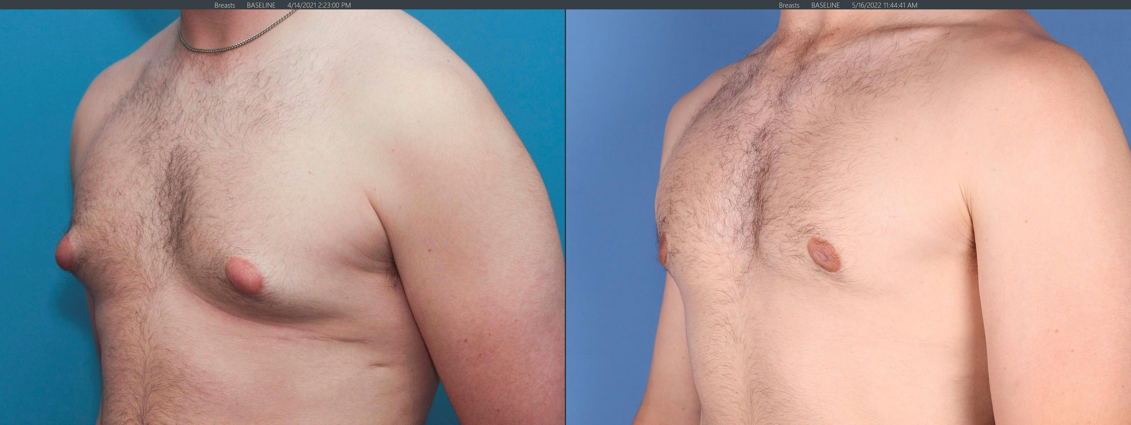 Male Breast Reduction Before & After Gallery - Patient 122832165 - Image 4