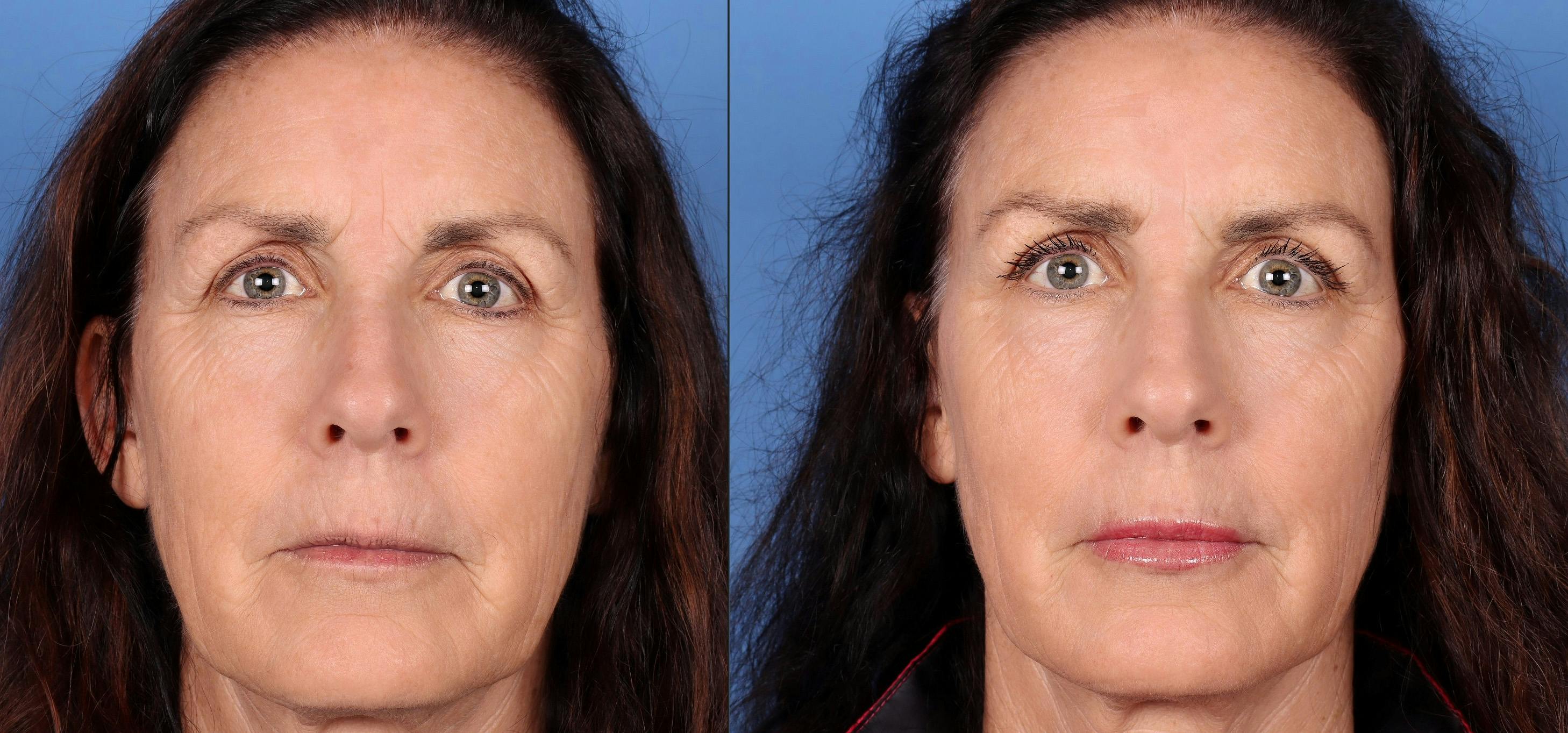 Lip Augmentation Before & After Gallery - Patient 122832242 - Image 1