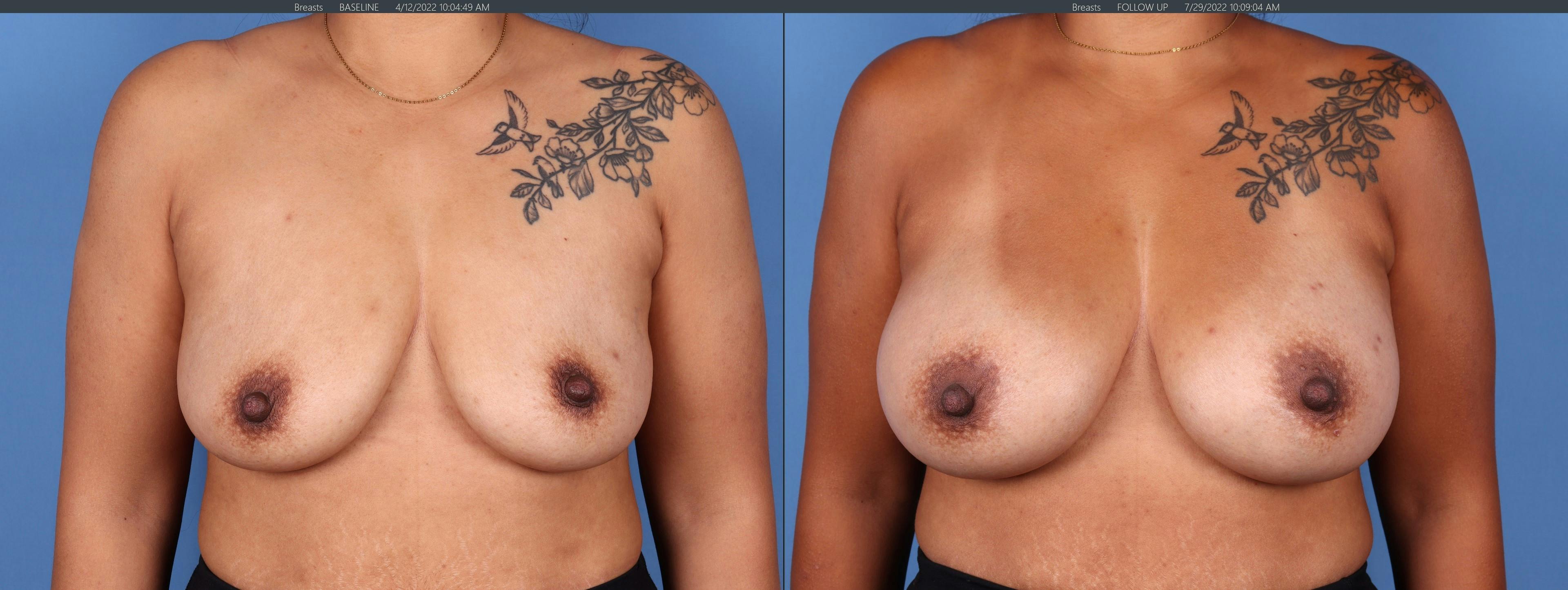 Breast Augmentation Before & After Gallery - Patient 123000303 - Image 1
