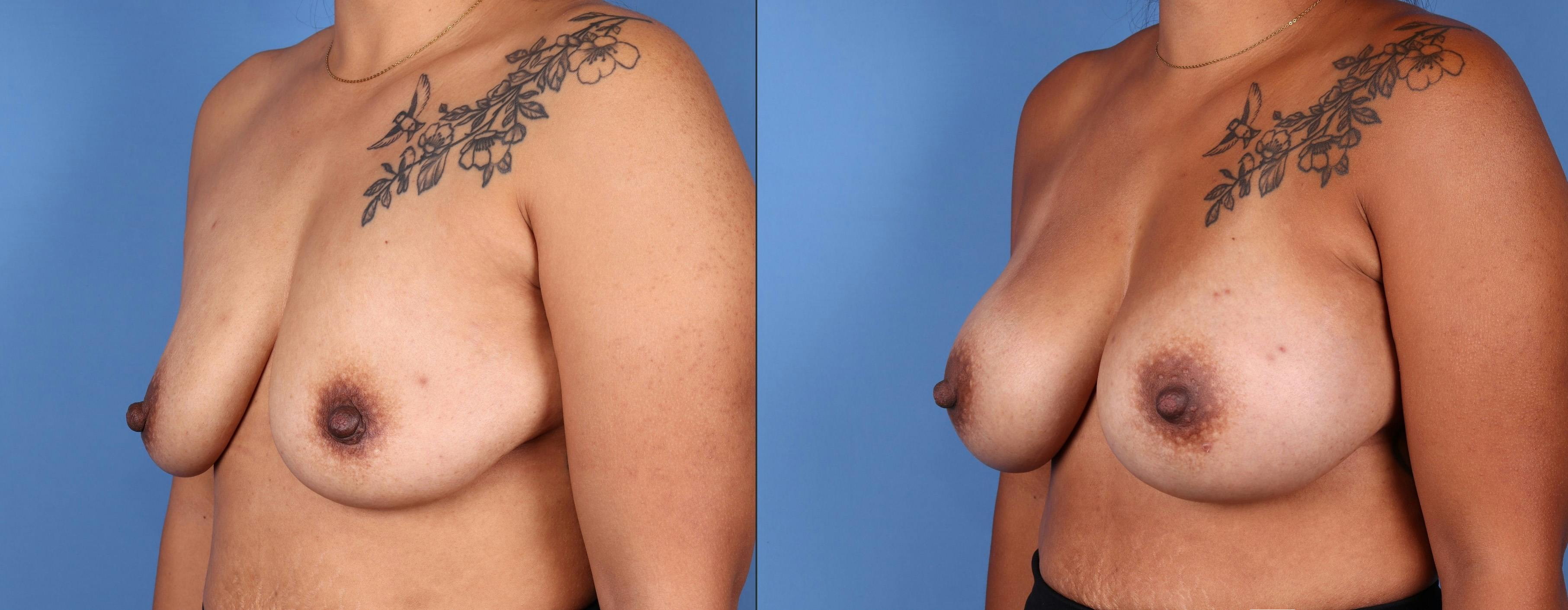 Breast Augmentation Before & After Gallery - Patient 123000303 - Image 2