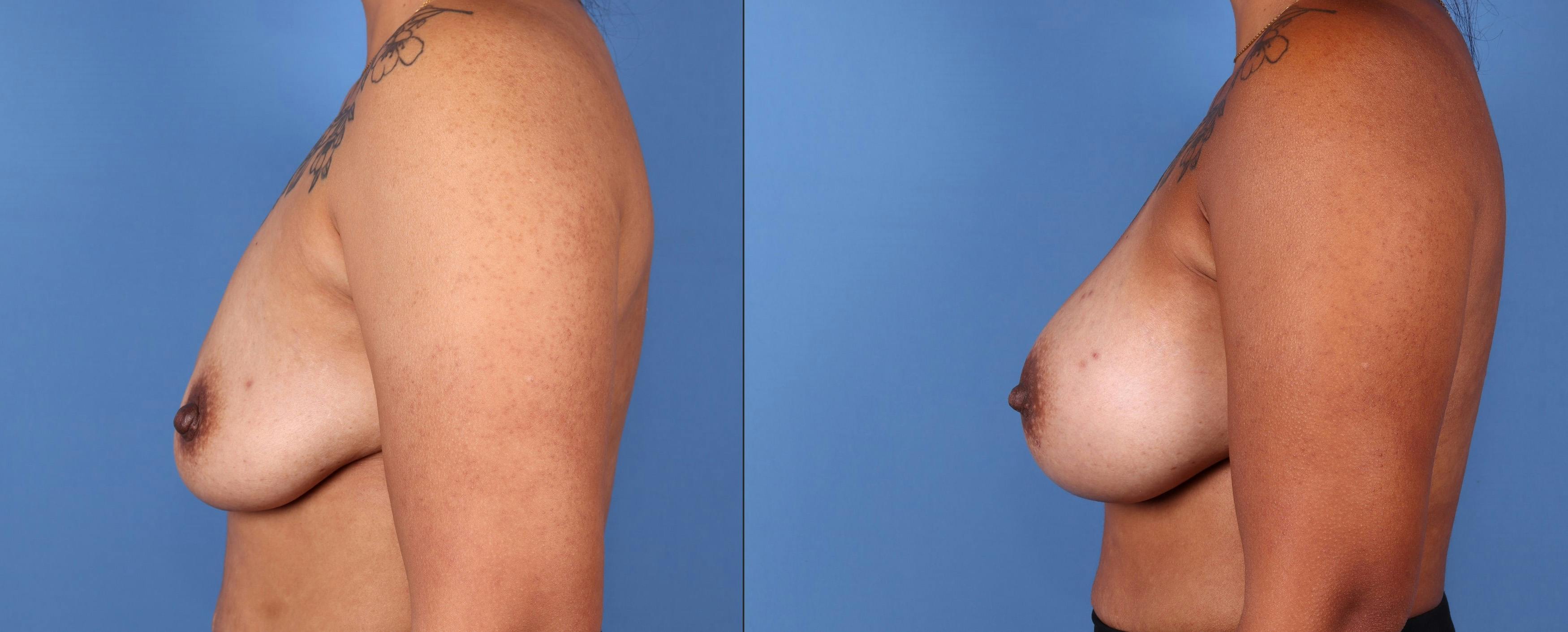 Breast Augmentation Before & After Gallery - Patient 123000303 - Image 3