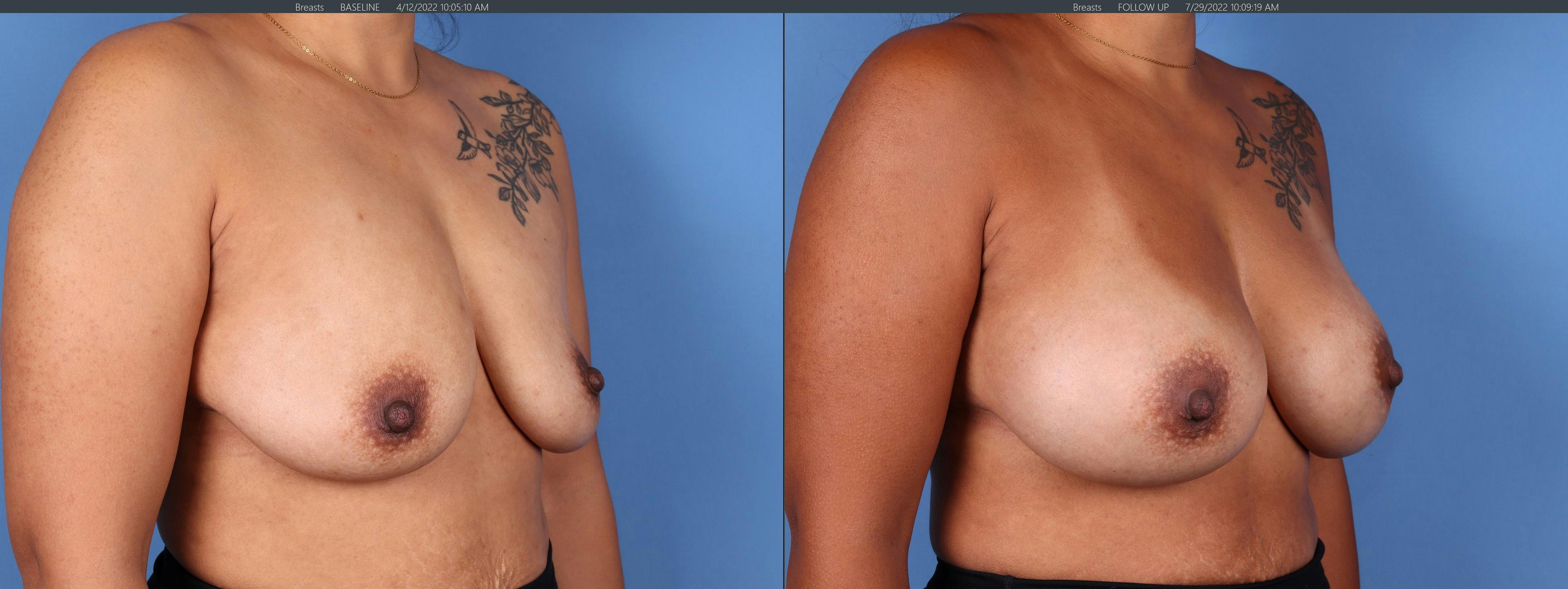 Breast Augmentation Before & After Gallery - Patient 123000303 - Image 4